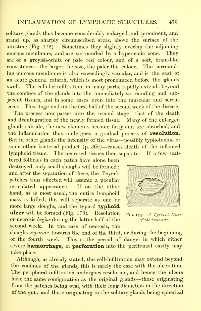 solitary glands thus become considerably enlarged and prominent^ and stand up, as sharply circumscribed areas, above the surface of the intestine (Fig. 172). Sometimes they slightly overlap the adjoining mucous membrane, and are surrounded by a hyperaemic zone. They are of a greyish-white or pale red colour, and of a soft, brain-like consistence—the larger the size, the paler the colour. The surround- ing mucous membrane is also exceedingly vascular, and is the seat of an acute general catarrh, which is most pronounced before the glands swell. The cellular infiltration, in many parts, rapidly extends beyond the confines of the glands into the immediately surrounding and sub- jacent tissues, and in some cases even into the muscular and serous coats. This stage ends in the first half of the second week of the disease. The process now passes into the second stage—that of the death and disintegration of the newly formed tissue. Many of the enlarged glands subside, the new elements become fatty and are absorbed, and the inflammation thus undergoes a gradual process of resolution. But in other glands the intensity of the virus—possibly typhotoxine or some other bacterial product (p. 362)—causes death of the inflamed lymphoid tissue. The necrosed tissues then separate. If a few scat- tered follicles in each patch have alone been destroyed, only small sloughs will be formed ; fp and after the separation of these, the Peyer's patches thus affected will assume a peculiar reticulated appearance. If on the other hand, as is most usual, the entire lymphoid mass is killed, this will separate as one or more large sloughs, and the typical typhoid ulcer will be formed (Fig. 173). Resolution ^ig. 173—A Typlu.id Ulcer or necrosis begins during the latter half of the of the Intesiiiie. second week. In the case of necrosis, the sloughs separate towards the end of the third, or during the beginning of the fourth week. This is the period of danger in which either severe haemorrhage, or perforation into the peritoneal cavity may take place. Although, as already stated, the cell-infiltration may extend beyond the confines of the glands, this is rarely the case with the ulceration. The peripheral infiltration undergoes resolution, and hence the ulcers have the same configuration as the original glands—those originating from the patches being oval, with their long diameters in the direction of the gut; and those originating in the solitary glands being spherical