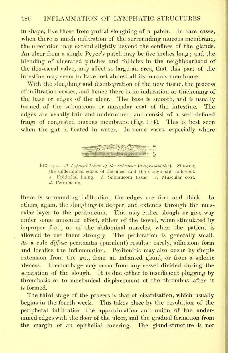 ill shape, like those from partial sloughing of a patch. In rare cases, when there is much infiltration of the surrounding mucous membrane, the ulceration may extend slightly beyond the confines of the glands. An ulcer from a single Peyer's patch may be five inches long; and the blending of ulcerated patches and follicles in the neighbourhood of the ileo-caecal valve, may affect so large an area, that this part of the intestine may seem to have lost almost all its mucous membrane. With the sloughing and disintegration of the new tissue, the process of infiltration ceases, and hence there is no induration or thickening of the base or edges of the ulcer. The base is smooth, and is usually formed of the submucous or muscular coat of the intestine. The edges are usually thin and undermined, and consist of a well-defined fringe of congested mucous membrane (Fig. 174). This is best seen when the gut is floated in water. In some cases, especially where i»(iSiiiitiiiiiiii^^ % Fig. 174.—A Typhoid Ulcer of the Intestine [diagraviuiatic). Showing the undermined edges of the ulcer and the slough still adherent. a. Epithelial lining. b. Submucous tissue, c. Muscular coat. d. Peritoneum. there is surrounding infiltration, the edges are firm and thick. In others, again, the sloughing is deeper, and extends tlirough the mus- cular layer to the peritoneum. This may either slough or give way under some muscular effort, either of the bowel, when stimulated by improper food, or of the abdominal muscles, when the patient is allowed to use them strongly. The perforation is generally small. As a rule diffuse peritonitis (purulent) results: rarely, adhesions form and localise the inflammation. Peritonitis may also occur by simple extension from the gut, from an inflamed gland, or from a splenic abscess. Haemorrhage may occur from any vessel divided during the separation of the slough. It is due either to insufficient plugging by thrombosis or to mechanical displacement of the thrombus after it is formed. The third stage of the process is that of cicatrisation, which usually begins in the fourth week. This takes place by the resolution of the peripheral infiltraticm, the approximation and union of the under- mined edges with the floor of the ulcer, and the gradual formation from the margin of an epithelial covering. The gland-structure is not