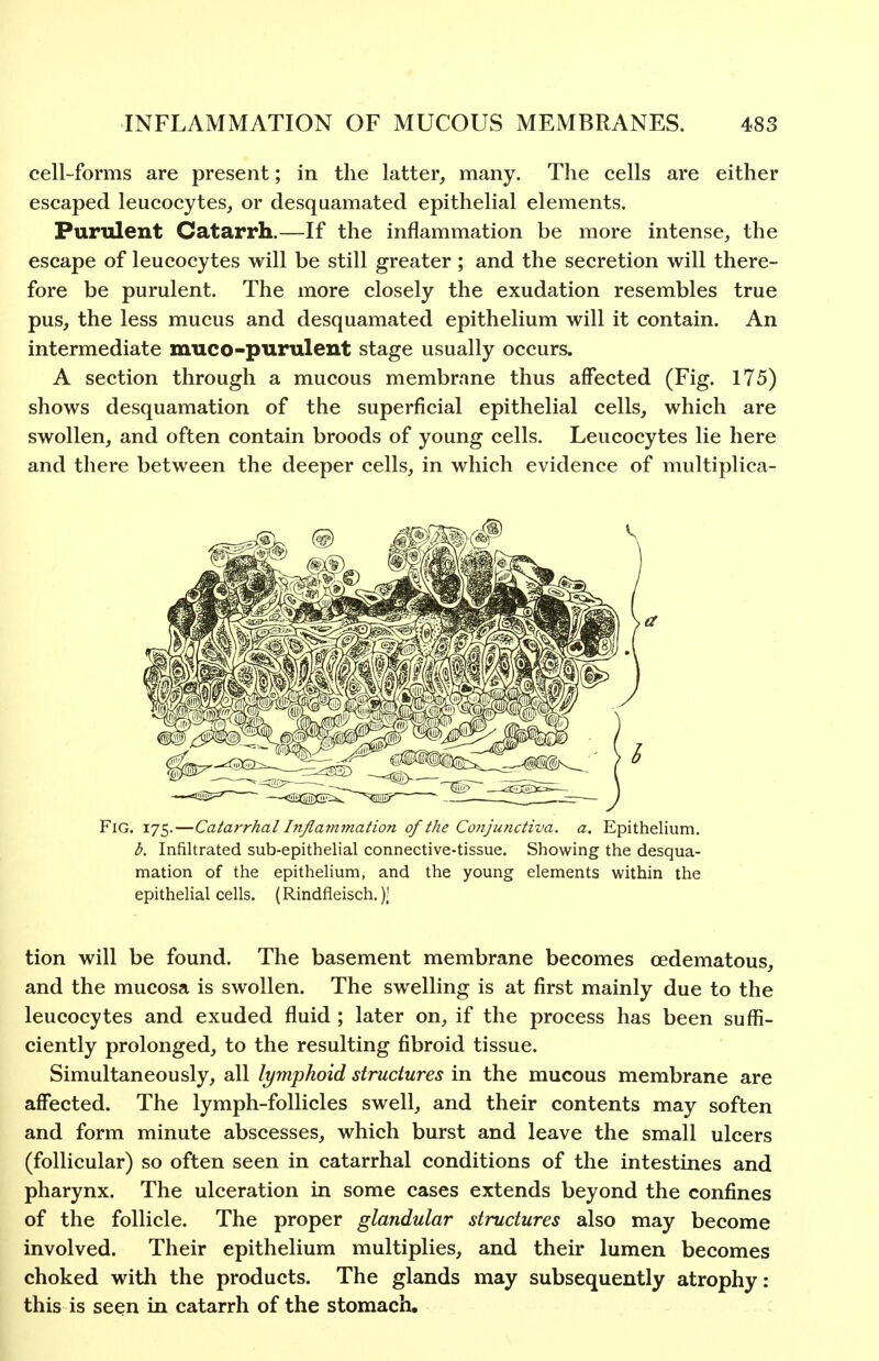 cell-forms are present; in the latter, many. The cells are either escaped leucocytes, or desquamated epithelial elements. Purulent Catarrh.—If the inflammation be more intense, the escape of leucocytes will be still greater ; and the secretion will there- fore be purulent. The more closely the exudation resembles true pus, the less mucus and desquamated epithelium will it contain. An intermediate muco-purulent stage usually occurs. A section through a mucous membrane thus affected (Fig. 175) shows desquamation of the superficial epithelial cells, which are swollen, and often contain broods of young cells. Leucocytes lie here and there between the deeper cells, in which evidence of multiplica- FiG. 175.—Catarrhal Infiaynmation of the Conjunctiva, a. Epithelium. b. Infiltrated sub-epithelial connective-tissue. Showing the desqua- mation of the epithehum, and the young elements within the epithehal cells. (Rindfleisch.); tion will be found. The basement membrane becomes oedematous, and the mucosa is swollen. The swelling is at first mainly due to the leucocytes and exuded fluid ; later on, if the process has been suffi- ciently prolonged, to the resulting fibroid tissue. Simultaneously, all lymphoid structures in the mucous membrane are affected. The lymph-follicles swell, and their contents may soften and form minute abscesses, which burst and leave the small ulcers (follicular) so often seen in catarrhal conditions of the intestines and pharynx. The ulceration in some cases extends beyond the confines of the follicle. The proper glandular structures also may become involved. Their epithelium multiplies, and their lumen becomes choked with the products. The glands may subsequently atrophy: this is seen in catarrh of the stomach.