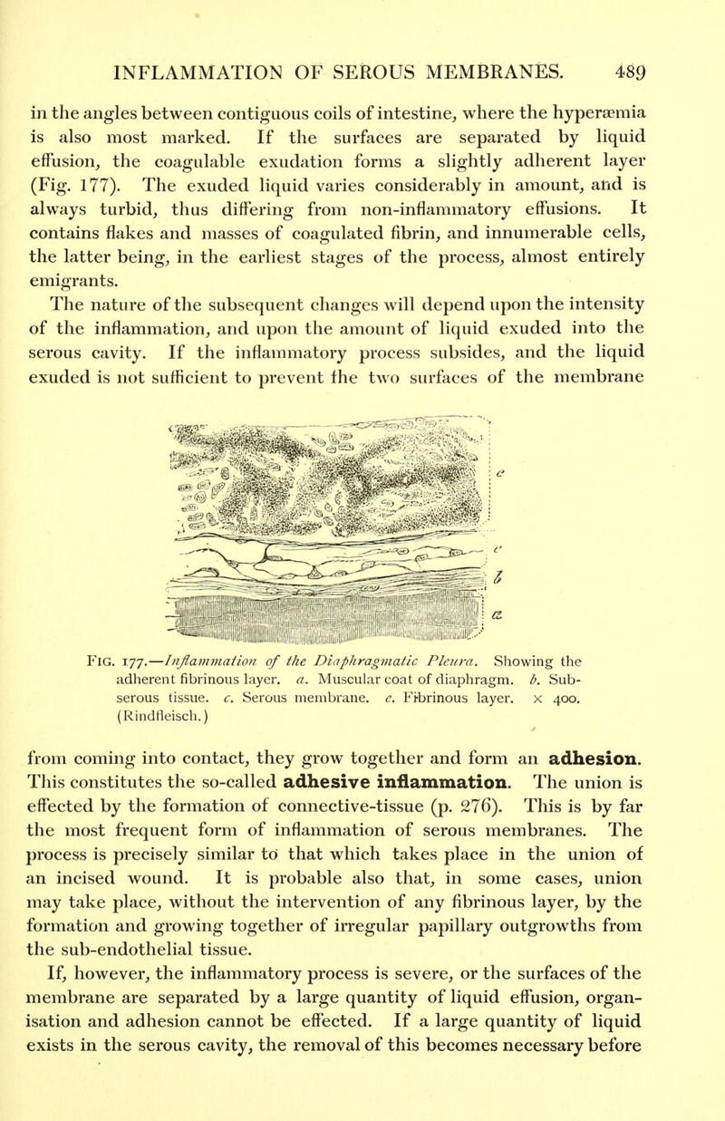 in the angles between contiguous coils of intestine^ where the hyperaemia is also most marked. If the surfaces are separated by liquid effusion, the coagulable exudation forms a slightly adherent layer (Fig. 177). The exuded liquid varies considerably in amount, and is always turbid, thus differing from non-inflammatory effusions. It contains flakes and masses of coagulated fibrin, and innumerable cells, the latter being, in the earliest stages of the process, almost entirely emigrants. The nature of the subsequent changes will depend upon the intensity of the inflammation, and upon the amount of liquid exuded into the serous cavity. If the inflammatory process subsides, and the liquid exuded is not sufficient to prevent the two surfaces of the membrane Fig. 177.—Inflammation of the Diaphragmatic Pleura. Sliowing the adherent fibrinous layer, a. Muscular coat of diaphragm, b. Sub- serous tissue, c. Serous membrane, e. Fi-brinous layer, x 400, (Rindfleisch.) from coming into contact, they grow together and form an adhesion. This constitutes the so-called adhesive inflammation. The union is effected by the formation of connective-tissue (p. 276). This is by far the most frequent form of inflammation of serous membranes. The process is precisely similar to that which takes place in the union of an incised wound. It is probable also that, in some cases, union may take place, without the intervention of any fibrinous layer, by the formation and growing together of irregular papillary outgrowths from the sub-endothelial tissue. If, however, the inflammatory process is severe, or the surfaces of the membrane are separated by a large quantity of liquid effusion, organ- isation and adhesion cannot be effected. If a large quantity of liquid exists in the serous cavity, the removal of this becomes necessary before