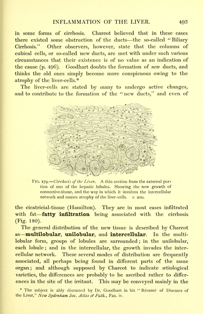 in some forms of cirrhosis. Charcot beHeved that in these cases there existed some obstruction of the ducts—the so-called Biliary- Cirrhosis. Other observers, however_, state that the columns of cubical cells, or so-called new ducts, are met with under such various circumstances that their existence is of no value as an indication of the cause (p. 496). Goodhart doubts the formation of new ducts, and thinks the old ones simply become more conspicuous owing to the atrophy of the liver-cells.* The liver-cells are stated by many to undergo active changes, and to contribute to the formation of the *^^new ducts, and even of Fig. 179,—Cirrhosis of the Liver. A thin section from the external por- tion of one of the hepatic lobules. Showing the new growth of connective-tissue, and the way in which it involves the intercellular network and causes atrophy of the liver-cells, x 200. the cicatricial-tissue (Hamilton). They are in most cases infiltrated with fat—fatty infiltration being associated with the cirrhosis (Fig. 180). The general distribution of the new tissue is described by Charcot as—multilobular, unilobular, and intercellular. In the multi- lobular form, groups of lobules are surrounded ; in the unilobular, each lobule; and in the intercellular, the growth invades the inter- cellular network. These several modes of distribution are frequently associated, all perhaps being found in different parts of the same organ; and although supposed by Charcot to indicate aetiological varieties, the differences are probably to be ascribed rather to differ- ences in the site of the irritant. This may be conveyed mainly in the * The subject is ably discussed by Dr. Goodhart in his '' R6sum6 of Diseases of the Liver, New Sydenham Soc. Atlas of Path., Fas. iv.