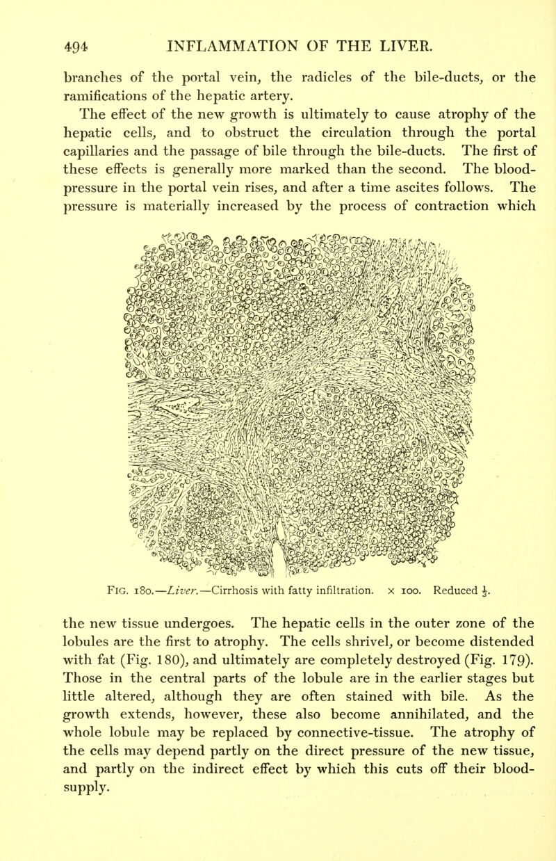 branches of the portal vein, the radicles of the bile-ducts, or the ramifications of the hepatic artery. The effect of the new growth is ultimately to cause atrophy of the hepatic cells, and to obstruct the circulation through the portal capillaries and the passage of bile through the bile-ducts. The first of these effects is generally more marked than the second. The blood- pressure in the portal vein rises, and after a time ascites follows. The pressure is materially increased by the process of contraction which Fig. i8o.—Liver.—Cirrhosis with fatty infiltration, x loo. Reduced \. the new tissue undergoes. The hepatic cells in the outer zone of the lobules are the first to atrophy. The cells shrivel, or become distended with fat (Fig. 180), and ultimately are completely destroyed (Fig. 179)- Those in the central parts of the lobule are in the earlier stages but little altered, although they are often stained with bile. As the growth extends, however, these also become annihilated, and the whole lobule may be replaced by connective-tissue. The atrophy of the cells may depend partly on the direct pressure of the new tissue, and partly on the indirect effect by which this cuts off their blood- supply.