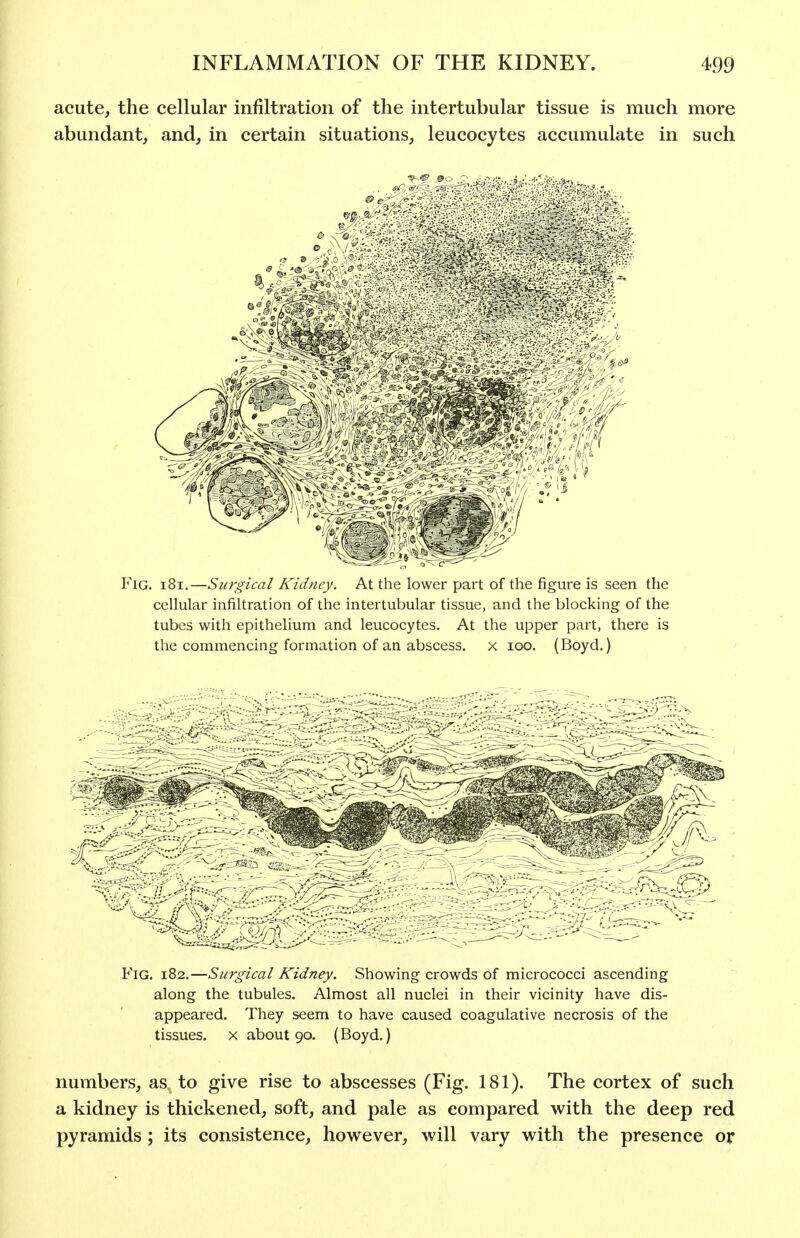 acute, the cellular infiltration of the intertubular tissue is much more abundant, and, in certain situations, leucocytes accumulate in such Fig. i8i.—Surgical Kidftcy. At the lower part of the figure is seen the cellular infiltration of the intertubular tissue, and the blocking of the tubes with epithelium and leucocytes. At the upper part, there is the commencing formation of an abscess, x loo. (Boyd.) Fig. 182.—Surgical Kidney. Showing crowds of micrococci ascending along the tubules. Almost all nuclei in their vicinity have dis- appeared. They seem to have caused coagulative necrosis of the tissues. X about 90. (Boyd,) numbers, as, to give rise to abscesses (Fig. 181). The cortex of such a kidney is thickened, soft, and pale as compared with the deep red pyramids ; its consistence, however, will vary with the presence or
