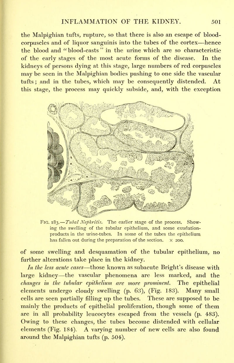 the Malpighian tufts^ rupture, so that there is also an escape of blood- corpuscles and of liquor sanguinis into the tubes of the cortex—hence the blood and blood-casts  in the urine which are so characteristic of the early stages of the most acute forms of the disease. In the kidneys of persons dying at this stage, large numbers of red corpuscles may be seen in the Malpighian bodies pushing to one side the vascular tufts; and in the tubes, which may be consequently distended. At this stage, the process may quickly subside, and, with the exception Fig. 183.—Tubal Nephritis. The earlier stage of the process. Show- ing the swelling of the tubular epithelium, and some exudation- products in the urine-tubes. In some of the tubes the epithelium has fallen out during the preparation of the section, x 200. of some swelling and desquamation of the tubular epithelium, no further alterations take place in the kidney. In the less acute cases—those known as subacute Bright's disease with large kidney—the vascular phenomena are less marked, and the changes in the tubular epithelunn are more prominent. The epithelial elements undergo cloudy swelling (p. 63), (Fig. 183). Many small cells are seen partially filling up the tubes. These are supposed to be mainly the products of epithelial proliferation, though some of them are in all probability leucocytes escaped from the vessels (p. 483). Owing to these changes, the tubes become distended with cellular elements (Fig. 184), A varying number of new cells are also found around the Malpighian tufts (p. 504).