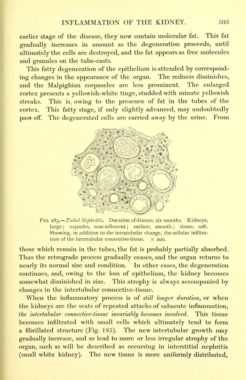 earlier stage of the disease, they now contain molecular fat. This fat gradually increases in amount as the degeneration proceeds, until ultimately the cells are destroyed, and the fat appears as free molecules and granules on the tube-casts. This fatty degeneration of the epithelium is attended by correspond- ing changes in the appearance of the organ. The redness diminishes, and the Malpighian corpuscles are less prominent. The enlarged cortex presents a yellowish-white tinge, studded with minute yellowish streaks. This is. owing to the presence of fat in the tubes of the cortex. This fatty stage, if only slightly advanced, may undoubtedly pass off. The degenerated cells are carried away by the urine. From Fig. 185.— Tubal Nephritis. Duration of disease, six months. Kidneys, large; capsules, non-adherent; surface, smooth; tissue, soft. Showing, in addition to the intratubular change, the cellular infiltra- tion of the intertubular connective-tissue, x 200. those which remain in the tubes, the fat is probably partially absorbed. Thus the retrograde process gradually ceases, and the organ returns to nearly its normal size and condition. In other cases, the degeneration continues, and, owing to the loss of epithelium, the kidney becomes somewhat diminished in size. This atrophy is always accompanied by changes in the intertubular connective-tissue. When the inflammatory process is of still longer duration, or when the kidneys are the seats of repeated attacks of subacute inflammation, the intertubular connective-tissue invariably becomes involved. This tissue becomes infiltrated with small cells which ultimately tend to form a fibrillated structure (Fig. 185). The new intertubular growth may gradually increase, and so lead to more or less irregular atrophy of the organ, such as will be described as occurring in interstitial nephritis (small white kidney). The new tissue is more uniformly distributed.
