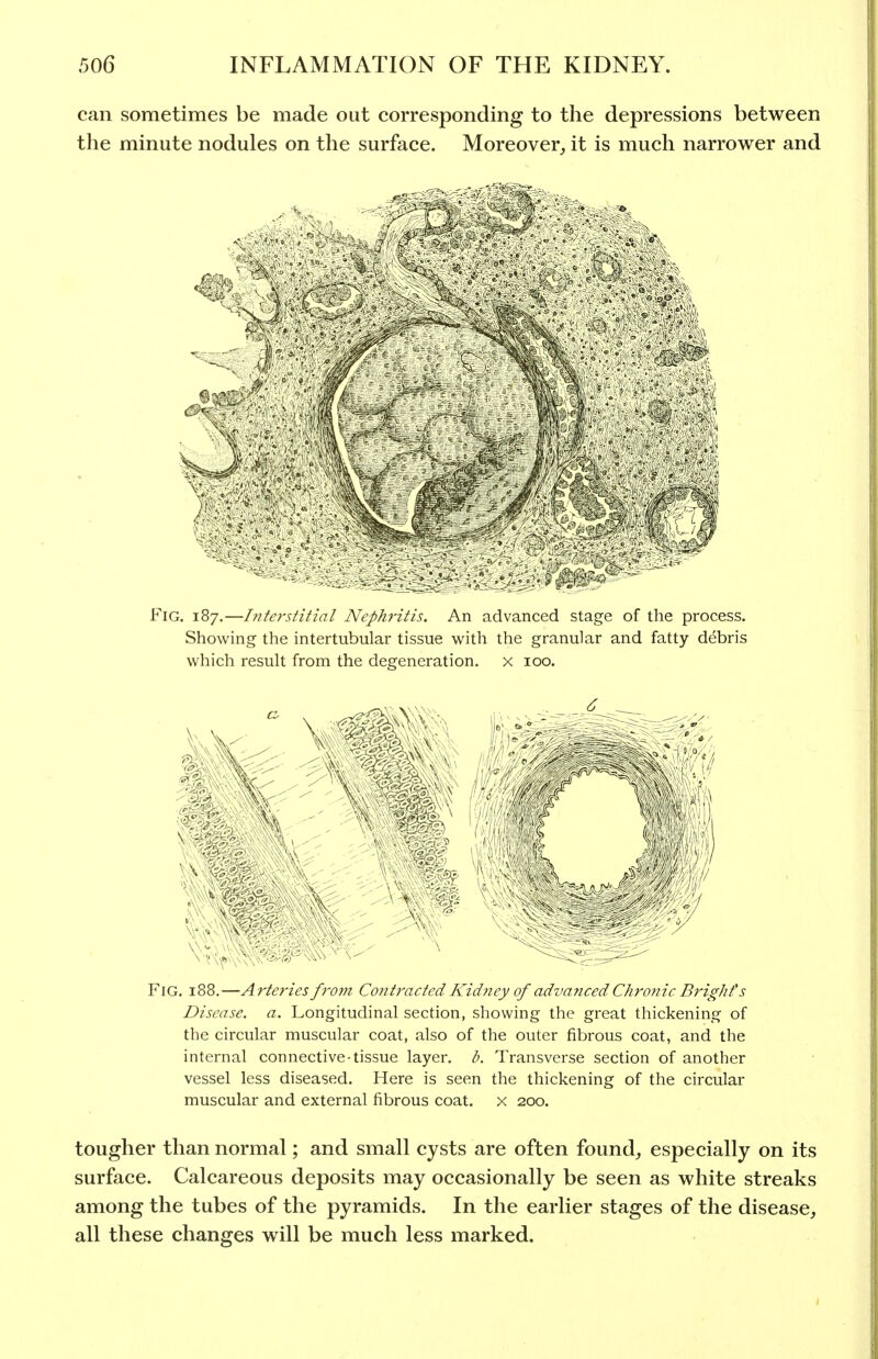can sometimes be made out corresponding to the depressions between the minute nodules on the surface. Moreover^ it is much narrower and Fig. 187.—hTterstitial Nephritis. An advanced stage of the process. Showing the intertubular tissue with the granular and fatty debris which result from the degeneration, x 100. Fig. 188.—Arteries from Contracted Kidjicy of advanced Chro7iic Bright's Disease, a. Longitudinal section, showing the great thickening of the circular muscular coat, also of the outer fibrous coat, and the internal connective-tissue layer. Transverse section of another vessel less diseased. Here is seen the thickening of the circular muscular and external fibrous coat, x 200. tougher than normal; and small cysts are often found, especially on its surface. Calcareous deposits may occasionally be seen as white streaks among the tubes of the pyramids. In the earlier stages of the disease, all these changes will be much less marked.