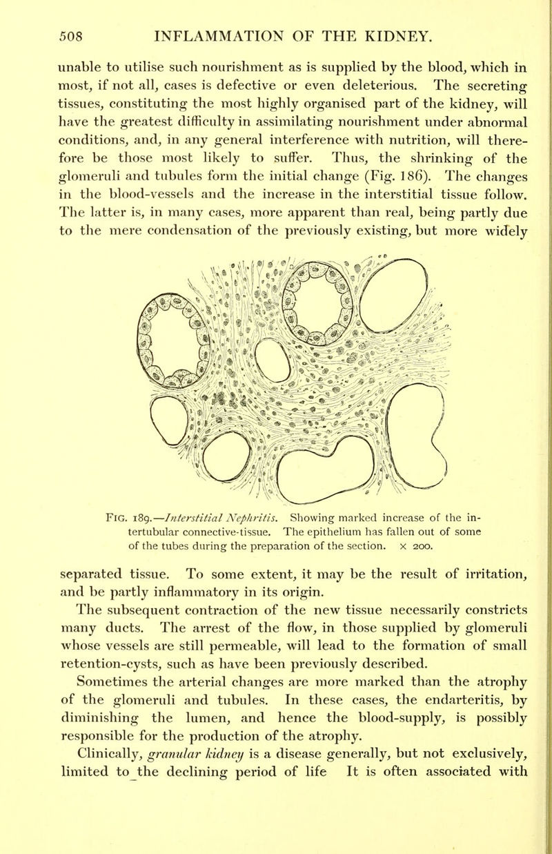 unable to utilise such nourishment as is supplied by the blood, which in most, if not all, cases is defective or even deleterious. The secreting tissues, constituting the most highly organised part of the kidney, will have the greatest difficulty in assimilating nourishment under abnormal conditions, and, in any general interference with nutrition, will there- fore be those most likely to suffer. Thus, the shrinking of the glomeruli and tubules form the initial change (Fig. 186). The changes in the blood-vessels and the increase in the interstitial tissue follow. The latter is, in many cases, more apparent than real, being partly due to tlie mere condensation of the previously existing, but more widely Fig. 189.—hiterstitial Nephritis. Showing marked increase of the in- tertubular connective-tissue. The epithehum has fallen out of some of the tubes during the preparation of the section, x 200. separated tissue. To some extent, it may be the result of irritation, and be partly inflammatory in its origin. The subsequent contraction of the new tissue necessarily constricts many ducts. The arrest of the flow, in those supplied by glomeruli whose vessels are still permeable, will lead to the formation of small retention-cysts, such as have been previously described. Sometimes the arterial changes are more marked than the atrophy of the glomeruli and tubules. In these cases, the endarteritis, by diminishing the lumen, and hence the blood-supply, is possibly responsible for the production of the atrophy. Clinically, granular kidney is a disease generally, but not exclusively, limited to the declining period of life It is often associated with