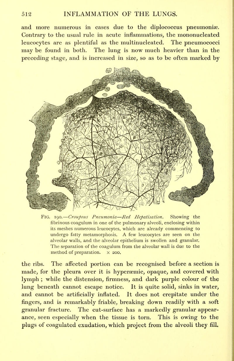 and more numerous in cases due to the diplococcus pneumoniae. Contrary to the usual rule in acute inflammations, the mononucleated leucocytes are as plentiful as the multinucleated. The pneumococci may be found in both. The lung is now much heavier than in the preceding stage, and is increased in size, so as to be often marked by Fig. 190.—Croupous Pneumonia—Red Hepatisation. Showing the fibrinous coagulum in one of the pulmonary alveoh, enclosing within its meshes numerous leucocytes, which are already commencing to undergo fatty metamorphosis. A few leucocytes are seen on the alveolar walls, and the alveolar epithehum is swollen and granular. The separation of the coagulum from the alveolar wall is due to the method of preparation, x 200. the ribs. The affected portion can be recognised before a section is made, for the pleura over it is hyperaemic, opaque, and covered with lymph ; while the distension, firmness, and dark purple colour of the lung beneath cannot escape notice. It is quite solid, sinks in water, and cannot be artificially inflated. It does not crepitate under the fingers, and is remarkably friable, breaking down readily with a soft granular fracture. The cut-surface has a markedly granular appear- ance, seen especially when the tissue is torn. This is owing to the plugs of coagulated exudation, which project from the alveoli they fill.