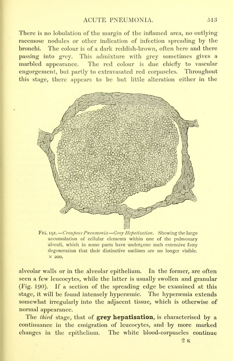 There is no lobulation of the margin of the inflamed area, no outlying racemose nodules or other indication of infection spreading by the bronchi. The colour is of a dark reddish-brown, often here and there passing into grey. This admixture with grey sometimes gives a marbled appearance. The red colour is due chiefly to vascular engorgement, but partly to extravasated red corpuscles. Throughout this stage, there appears to be but little alteration either in the Fig. 191.—Croupous P?ieumonia—Grey Hepatisatio7i. Showing the large accumulation of cellular elements within one of the pulmonary alveoli, which in some parts have undergone such extensive fatty degeneration that their distinctive outlines are no longer visible. X 200. alveolar walls or in the alveolar epithelium. In the former, are often seen a few leucocytes, while the latter is usually swollen and granular (Fig. 190). If a section of the spreading edge be examined at this stage, it will be found intensely hypersemic. The hyperaemia extends somewhat irregularly into the adjacent tissue, which is otherwise of normal appearance. The tJiird stage, that of grey hepatisation, is characterised by a continuance in the emigration of leucocytes, and by more marked changes in the epithelium. The white blood-corpuscles continue