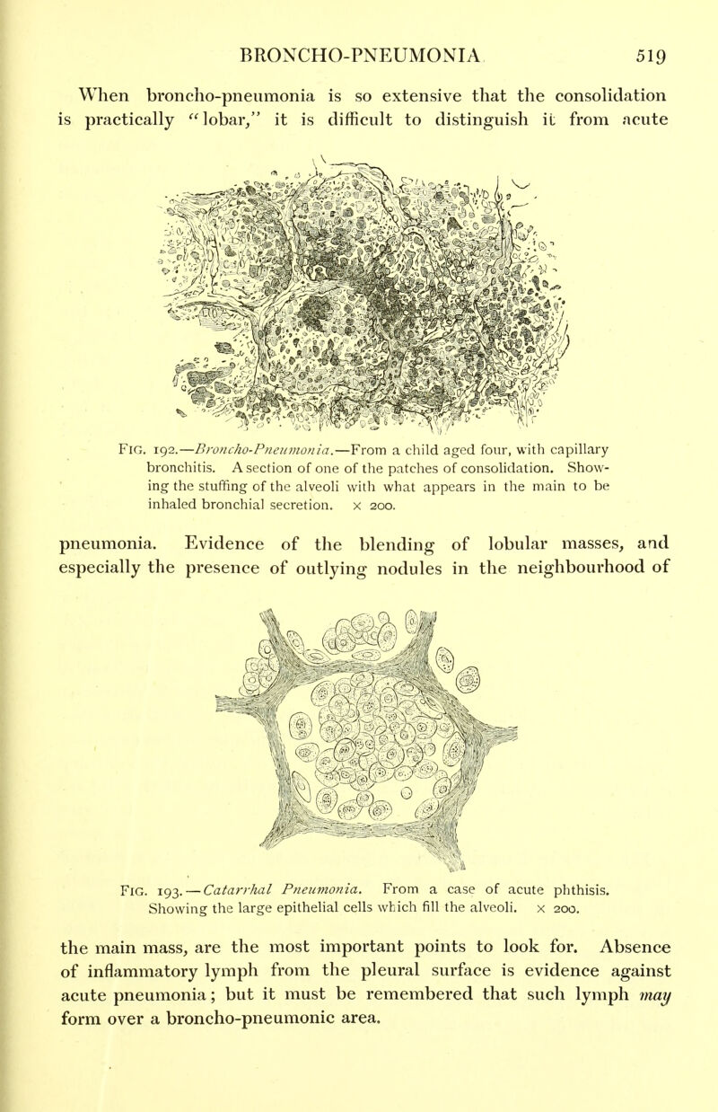 When broncho-pneumonia is so extensive that the consolidation is practically lobar/' it is difficult to distinguish it from acute Fig, 192.—Broncho-Pneumonia.—From a child aged four, with capillary bronchitis. A section of one of the patches of consolidation. Show- ing the stuffing of the alveoli with what appears in the main to be inhaled bronchial secretion, x 200. pneumonia. Evidence of the blending of lobular masses, and especially the presence of outlying nodules in the neighbourhood of Fig. 193. — Catarrhal Pneumonia. From a case of acute phthisis. Showing the large epithehal cells which fill the alveoli, x 200. the main mass, are the most important points to look for. Absence of inflammatory lymph from the pleural surface is evidence against acute pneumonia; but it must be remembered that such lymph may form over a broncho-pneumonic area.