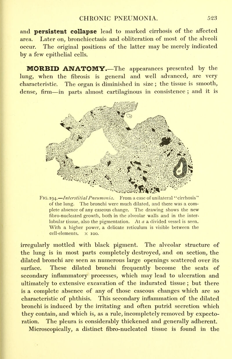 and persistent collapse lead to marked cirrhosis of the affected area. Later on, bronchiectasis and obliteration of most of the alveoli occur. The original positions of the latter may be merely indicated by a few epithelial cells. MORBID ANATOMY.—The appearances presented by the lung, when the fibrosis is general and well advanced, are very characteristic. The organ is diminished in size ; the tissue is smooth, dense, firm—in parts almost cartilaginous in consistence ; and it is Fig. 194.—Interstitial Pneumonia. From a case of unilateral'' cirrhosis  of the lung. The bronchi were much dilated, and there was a com- plete absence of any caseous change. The drawing shows the new fibro-nucleated growth, both in the alveolar walls and in the inter- lobular tissue, also the pigmentation. At a divided vessel is seen. With a higher power, a delicate reticulum is visible between the cell-elements, x 100. irregularly mottled with black pigment. The alveolar structure of the lung is in most parts completely destroyed, and on section, the dilated bronchi are seen as numerous large openings scattered over its surface. These dilated bronchi frequently become the seats of secondary inflammatory processes, which may lead to ulceration and ultimately to extensive excavation of the indurated tissue; but there is a complete absence of any of those caseous changes which are so characteristic of phthisis. This secondary inflammation of the dilated bronchi is induced by the irritating and often putrid secretion which they contain, and which is, as a rule, incompletely removed by expecto- ration. The pleura is considerably thickened and generally adherent. Microscopically, a distinct fibro-nucleated tissue is found in the