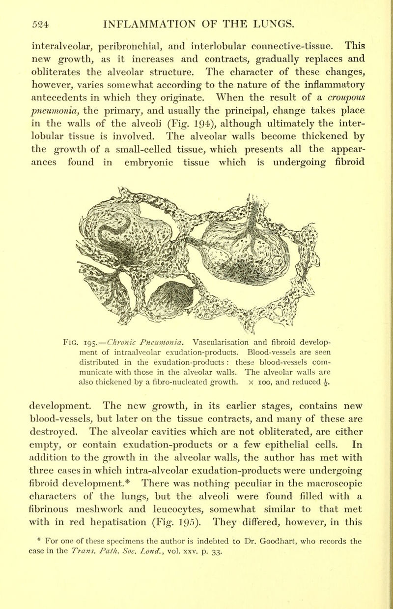 interalveolar, peribronchial, and interlobular connective-tissue. This new growth, as it increases and contracts, gradually replaces and obliterates the alveolar structure. The character of these changes, however, varies somewhat according to the nature of the inflammatory antecedents in which they originate. When the result of a croupous pneumonia, the primary, and usually the principal, change takes place in the walls of the alveoli (Fig. 194), although ultimately the inter- lobular tissue is involved. The alveolar walls become thickened by the growth of a small-celled tissue, which presents all the appear- ances found in embryonic tissue which is undergoing fibroid Fig. 195.—Chronic Pncu?nonia. Vascularisation and fibroid develop- ment of intraalveolar exudation-products. Blood-vessels are seen distributed in the exudation-products : these blood-vessels com- municate with those in the alveolar walls. The alveolar walls are also thickened by a fibro-nucleated growth, x 100, and reduced \. development. The new growth, in its earlier stages, contains new blood-vessels, but later on the tissue contracts, and many of these are destroyed. The alveolar cavities which are not obliterated, are either empty, or contain exudation-products or a few epithelial cells. In addition to the growth in the alveolar walls, the author has met with three cases in which intra-alveolar exudation-products were undergoing fibroid development.* There was nothing peculiar in the macroscopic characters of the lungs, but the alveoli were found filled with a fibrinous meshwork and leucocytes, somewhat similar to that met with in red hepatisation (Fig. 195). They differed, however, in this * For one of these specimens the author is indebted to Dr. Goodhart, who records the case in the Trans. Path. Soc. Lond., vol. xxv. p. 33.