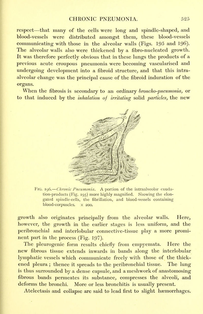 respect—that many of the cells were long and spindle-shaped, and blood-vessels were distributed amongst them, these blood-vessels communicating with those in the alveolar walls (Figs. 195 and I96). The alveolar walls also were thickened by a fibro-nucleated growth. It was therefore perfectly obvious that in these lungs the products of a previous acute croupous pneumonia were becoming vascularised and undergoing development into a fibroid structure, and that this intra- alveolar change was the principal cause of the fibroid induration of the organs. When the fibrosis is secondary to an ordinary hroncho-pimimonia, or to that induced by the inhalation of irritating solid particles, the new Fig. 196.—Chronic Pneumonia. A portion of the intraalveolar exuda- tion-products (Fig. 195) more highly magnified. Sliowing the elon- gated spindle-cells, the fibrillation, and blood-vessels containing blood-corpuscles, x 200. growth also originates principally from the alveolar walls. Here, however, the growth in the earlier stages is less uniform, and the peribronchial and interlobular connective-tissue play a more promi- nent part in the process (Fig. 197). The pleurogenic form results chiefly from empyemata. Here the new fibrous tissue extends inwards in bands along the interlobular lymphatic vessels which communicate freely with those of the thick- ened pleura ; thence it spreads to the peribronchial tissue. The lung is thus surrounded by a dense capsule, and a meshwork of anastomosing fibrous bands permeates its substance, compresses the alveoli, and deforms the bronchi. More or less bronchitis is usually present. Atelectasis and collapse are said to lead first to slight haemorrhages.