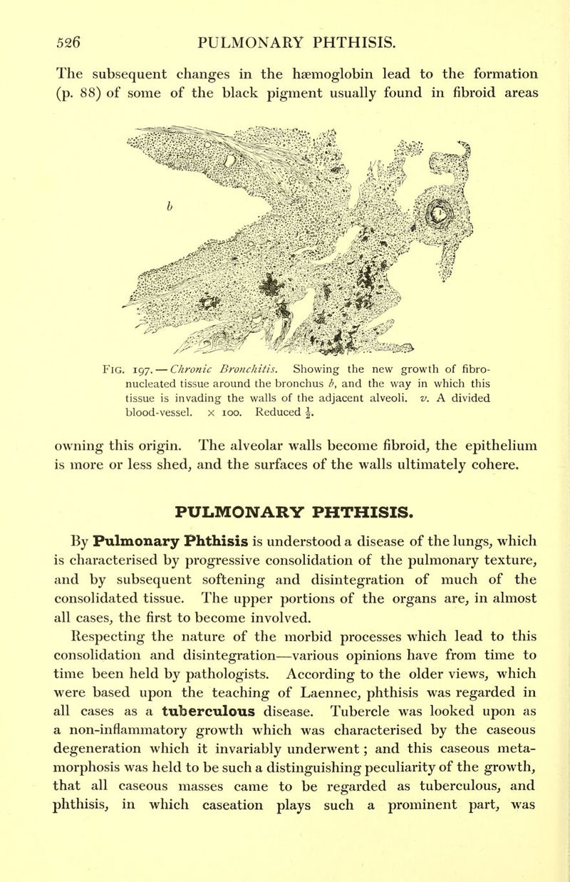 The subsequent changes in the haemoglobin lead to the formation (p. 88) of some of the black pigment usually found in fibroid areas Fig. 197. — Chronic Bronchitis. Showing the new growth of fibro- nucleated tissue around the bronchus b, and the way in which this tissue is invading the walls of the adjacent alveoli, v. A divided blood-vessel, x 100. Reduced \. owning this origin. The alveolar walls become fibroid, the epithelium is more or less shed, and the surfaces of the walls ultimately cohere. PULMONARY PHTHISIS. By Pulmonary Phthisis is understood a disease of the lungs, which is characterised by progressive consolidation of the pulmonary texture, and by subsequent softening and disintegration of much of the consolidated tissue. The upper portions of the organs are, in almost all cases, the first to become involved. Respecting the nature of the morbid processes which lead to this consolidation and disintegration—various opinions have from time to time been held by pathologists. According to the older views, which were based upon the teaching of Laennec, phthisis was regarded in all cases as a tuberculous disease. Tubercle was looked upon as a non-inflammatory growth which was characterised by the caseous degeneration which it invariably underwent; and this caseous meta- morphosis was held to be such a distinguishing peculiarity of the growth, that all caseous masses came to be regarded as tuberculous, and phthisis, in which caseation plays such a prominent part, was