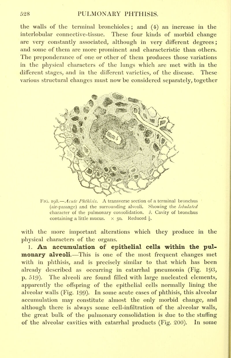 the walls of the terminal bronchioles ; and (4) an increase in the interlobular connective-tissue. These four kinds of morbid change are very constantly associated, although in very different degrees; and some of them are more prominent and characteristic than others. The preponderance of one or other of them produces those variations in the physical characters of the lungs which are met with in the different stages, and in the different varieties, of the disease. These various structural changes must now be considered separately, together Fig. 198.—Acute Phthisis. A transverse section of a terminal bronchus (air-passage) and the surrounding alveoH. Showing the lobulatcd character of the pulmonary consolidation, b. Cavity of bronchus containing a little mucus, x 50. Reduced \. with the more important alterations which they produce in the physical characters of the organs. 1. An accumulation of epithelial cells within the pul- monary alveoli.—This is one of the most frequent changes met with in phthisis, and is precisely similar to that which has been already described as occurring in catarrhal pneumonia (Fig. 193, p. 519). The alveoli are found filled with large nucleated elements, apparently the offspring of the epithelial cells normally lining the alveolar walls (Fig. 199)- In some acute cases of phthisis, this alveolar accumulation may constitute almost the only morbid change, and although there is always some cell-infiltration of the alveolar walls, the great bulk of the pulmonary consolidation is due to the stuffing of the alveolar cavities with catarrhal products (Fig. 200). In some