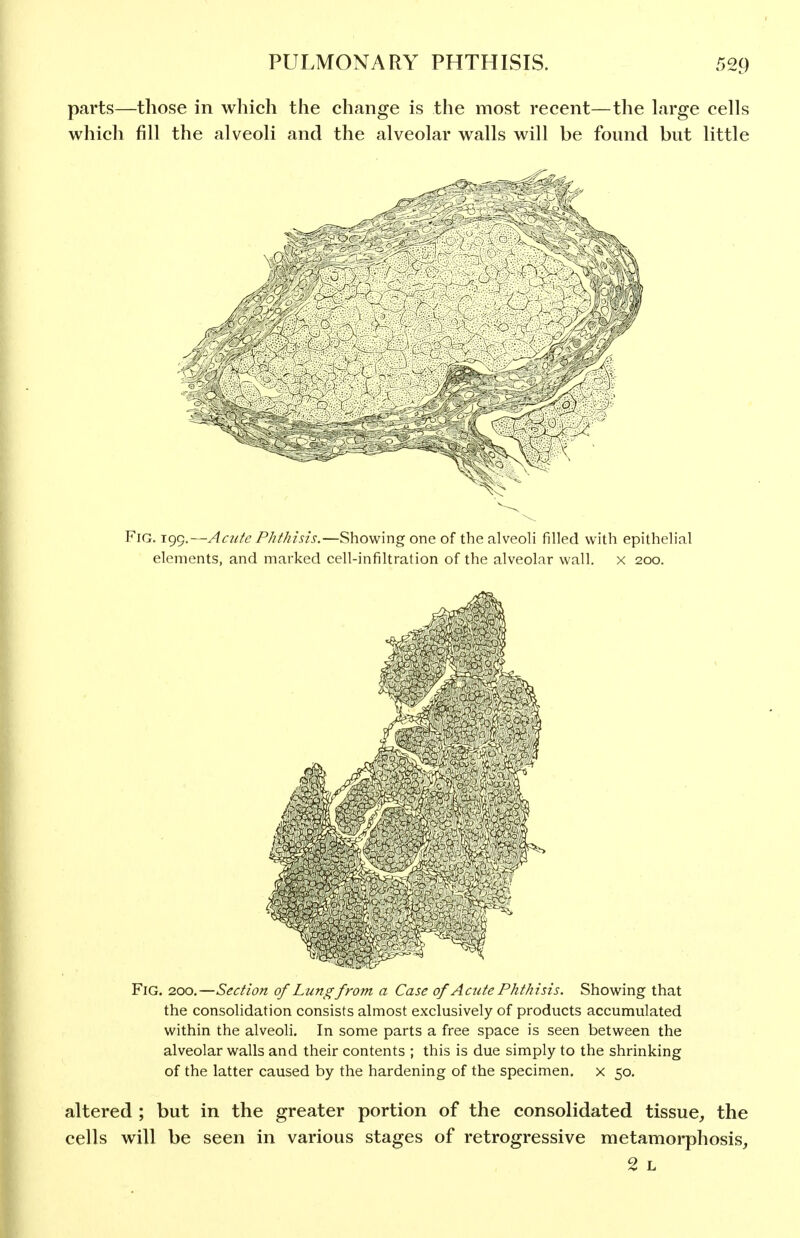 parts—those in which tiie change is the most recent—the large cells which fill the alveoli and the alveolar walls will be found but little Fig. 199.—Acute Phthisis.—Showing one of the alveoli filled with epithelial elements, and marked cell-infiltration of the alveolar wall, x 200. Fig. 200.—Section of Lung from a Case of Acute Phthisis. Showing that the consolidation consists almost exclusively of products accumulated within the alveoli. In some parts a free space is seen between the alveolar walls and their contents ; this is due simply to the shrinking of the latter caused by the hardening of the specimen, x 50. altered ; but in the greater portion of the consolidated tissue, the cells will be seen in various stages of retrogressive metamorphosis, 2 L