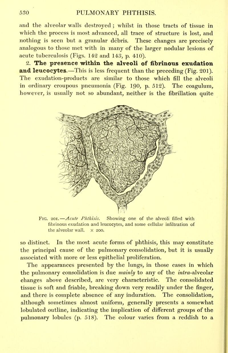 and the alveolar walls destroyed ; whilst in those tracts of tissue in which the process is most advanced, all trace of structure is lost, and nothing is seen but a granular debris. These changes are precisely analogous to those met with in many of the larger nodular lesions of acute tuberculosis (Figs. 142 and 143, p. 410). 2. The presence within the alveoli of fibrinous exudation and leucocytes.—This is less frequent than the preceding (Fig. 201). The exudation-products are similar to those which fill the alveoli in ordinary croupous pneumonia (Fig. I90, p. 512). The coagulum, however, is usually not so abundant, neither is the fibrillation quite Fig. 201,—Acute Phthisis. Showing one of the alveoh filled with fibrinous exudation and leucocytes, and some cellular infiltration of the alveolar wall, x 200. so distinct. In the most acute forms of phthisis, this may constitute the principal cause of the pulmonary consolidation, but it is usually associated with more or less epithelial proliferation. The appearances presented by the lungs, in those cases in which the pulmonary consolidation is due mainly to any of the m^ra-alveolar changes above described, are very characteristic. The consolidated tissue is soft and friable, breaking down very readily under the finger, and there is complete absence of any induration. The consolidation, although sometimes almost uniform, generally presents a somewhat lobulated outline, indicating the implication of different groups of the pulmonary lobules (p. 518). The colour varies from a reddish to a