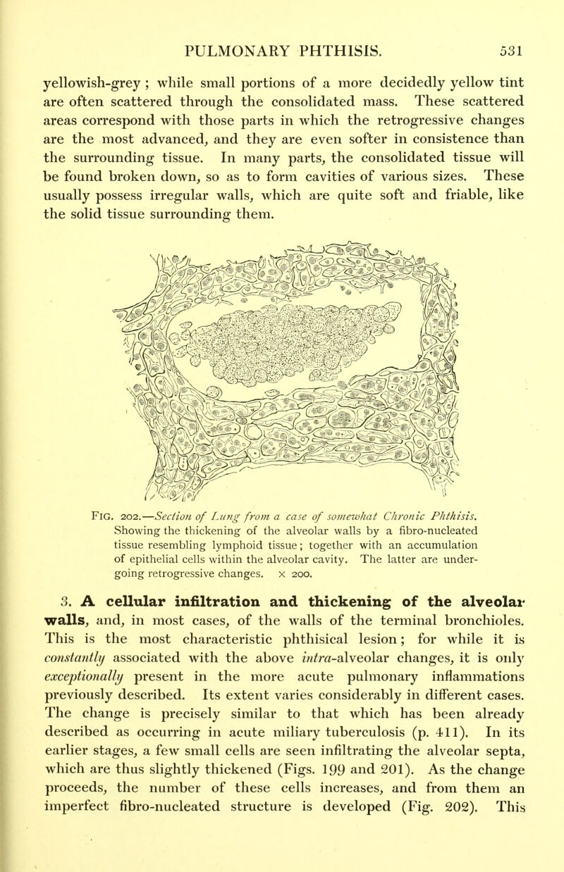 yellowish-grey ; while small portions of a more decidedly yellow tint are often scattered through the consolidated mass. These scattered areas correspond with those parts in which the retrogressive changes are the most advanced, and they are even softer in consistence than the surrounding tissue. In many parts, the consolidated tissue will be found broken down, so as to form cavities of various sizes. These usually possess irregular walls, which are quite soft and friable, like the solid tissue surrounding them. Fig. 202.—Section of Lung from a case of somewhat Chronic Phthisis. Showing the thickening of the alveolar walls by a fibro-nucleated tissue resembling lymphoid tissue; together with an accumulation of epithelial cells within the alveolar cavity. The latter are under- going retrogressive changes, x 200. 3. A cellular infiltration and thickening of the alveolar walls, and, in most cases, of the walls of the terminal bronchioles. This is the most characteristic phthisical lesion; for while it is constantly associated with the above zwim-alveolar changes, it is only exceptionally present in the more acute pulmonary inflammations previously described. Its extent varies considerably in different cases. The change is precisely similar to that which has been already described as occurring in acute miliary tuberculosis (p. 411). In its earlier stages, a few small cells are seen infiltrating the alveolar septa, which are thus slightly thickened (Figs. 199 and 201), As the change proceeds, the number of these cells increases, and from them an imperfect fibro-nucleated structure is developed (Fig. 202). This