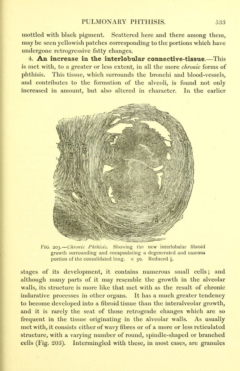 mottled with black pigment. Scattered here and there among them, may be seen yellowish patches corresponding to the portions which have undergone retrogressive fatty changes. 4. An increase in the interlobular connective-tissue.—This is met with, to a greater or less extent, in all the more chronic forms of phthisis. This tissue, which surrounds the bronchi and blood-vessels, and contributes to the formation of the alveoli, is found not only increased in amount, but also altered in character. In the earlier Fig. 203.—Chronic Phthisis. Showing the new interlobular fibroid growth surrounding and encapsulating a degenerated and caseous portion of the consolidated lung, x 50. Reduced ^. stages of its development, it contains numerous small cells; and although many parts of it may resemble the growth in the alveolar walls, its structure is more like that met with as the result of chronic indurative processes in other organs. It has a much greater tendency to become developed into a fibroid tissue than the interalveolar growth, and it is rarely the seat of those retrograde changes which are so frequent in the tissue originating in the alveolar walls. As usually met with, it consists either of wavy fibres or of a more or less reticulated structure, with a varying number of round, spindle-shaped or branched cells (Fig. 203). Intermingled with these, in most cases, are granules