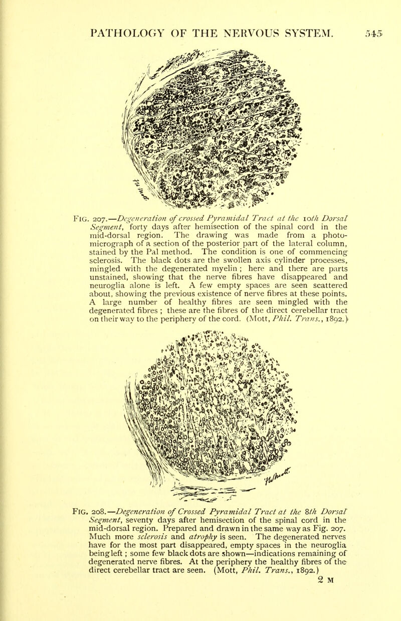 Fig. 207.—Degcneratiofi of crossed Pyramidal Tract at the lot/i Dorsal Segment, forty days after hemisection of the spinal cord in the mid-dorsal region. The drawing was made from a photo- micrograph of a section of the posterior part of the lateral column, stained by the Pal method. The condition is one of commencing sclerosis. The black dots are the swollen axis cylinder processes, mingled with the degenerated myelin ; here and there are parts unstained, showing that the nerve fibres have disappeared and neuroglia alone is left. A few empty spaces are seen scattered about, showing the previous existence of nerve fibres at these points. A large number of healthy fibres are seen mingled with the degenerated fibres ; these are the fibres of the direct cerebellar tract on their way to the periphery of the cord. (Mott, Phil. Trans., 1892.) »0i^>, '\ »*^r:-'' 'C-Ui ©«c Fig. 208.—Degeneration of Crossed Pyramidal Tract at the ^th Dorsal' Se^ynent, seventy days after hemisection of the spinal cord in the mid-dorsal region. Prepared and drawn in the same way as Fig. 207. Much more sclerosis and atrophy is seen. The degenerated nerves have for the most part disappeared, empty spaces in the neuroglia being left; some few black dots are shown—indications remaining of degenerated nerve fibres. At the periphery the healthy fibres of the direct cerebellar tract are seen. (Mott, Phil, Trans., 1892.) 2 M