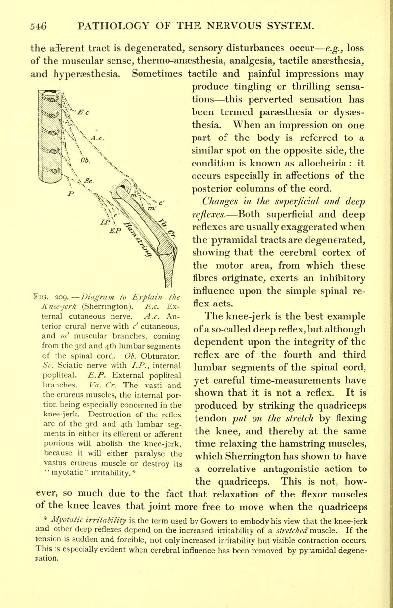 the afferent tract is degenerated, sensory disturbances occur—e.g., loss of the muscular sense, thermo-ansesthesia, analgesia, tactile anaesthesia, and hyperaesthesia. Sometimes tactile and painful impressions may produce tingling or thrilling sensa- tions—this perverted sensation has been termed paraesthesia or dysses- thesia. When an impression on one part of the body is referred to a similar spot on the opposite side, the condition is known as allocheiria : it occurs especially in affections of the posterior columns of the cord. Changes in the sujyerficial and deep rejiexes.—Both superficial and deep reflexes are usually exaggerated when the pyramidal tracts are degenerated, showing that the cerebral cortex of the motor area, from which these fibres originate, exerts an inhibitory influence upon the simple spinal re- flex acts. The knee-jerk is the best example of a so-called deep reflex, but although dependent upon the integrity of the reflex arc of the fourth and third lumbar segments of the spinal cord, yet careful time-measurements have shown that it is not a reflex. It is produced by striking the quadriceps tendon pid on the stretch by flexing the knee, and thereby at the same time relaxing the hamstring muscles, which Sherrington has shown to have a correlative antagonistic action to the quadriceps. This is not, how- ever, so much due to the fact that relaxation of the flexor muscles of the knee leaves that joint more free to move when the quadriceps * Myotatic irritability is the term used by Gowers to embody his view that the knee-jerk and other deep reflexes depend on the increased irritability of a stretched muscle. If the tension is sudden and forcible, not only increased irritability but visible contraction occurs. This is especially evident when cerebral influence has been removed by pyramidal degene- JQ. 209. —Diagrajn to Explai/i the Knee-jerk (Sherrington). E.c. Ex- ternal cutaneous nerve. A.c. An- terior crural nerve with c' cutaneous, and m' muscular branches, coming from the 3rd and 4th lumbar segments of the spinal cord. Ob. Obturator. Sc. Sciatic nerve with I.P., internal pophteal. E.P. External pophteal branches. Va. Cr. The vasti and the crureus muscles, the internal por- tion being especially concerned in the knee-jerk. Destruction of the reflex arc of the 3rd and 4th lumbar seg- ments in either its efferent or afferent portions will abolish the knee-jerk, because it will either paralyse the vastus crureus muscle or destroy its myotatic  irritabihty.*