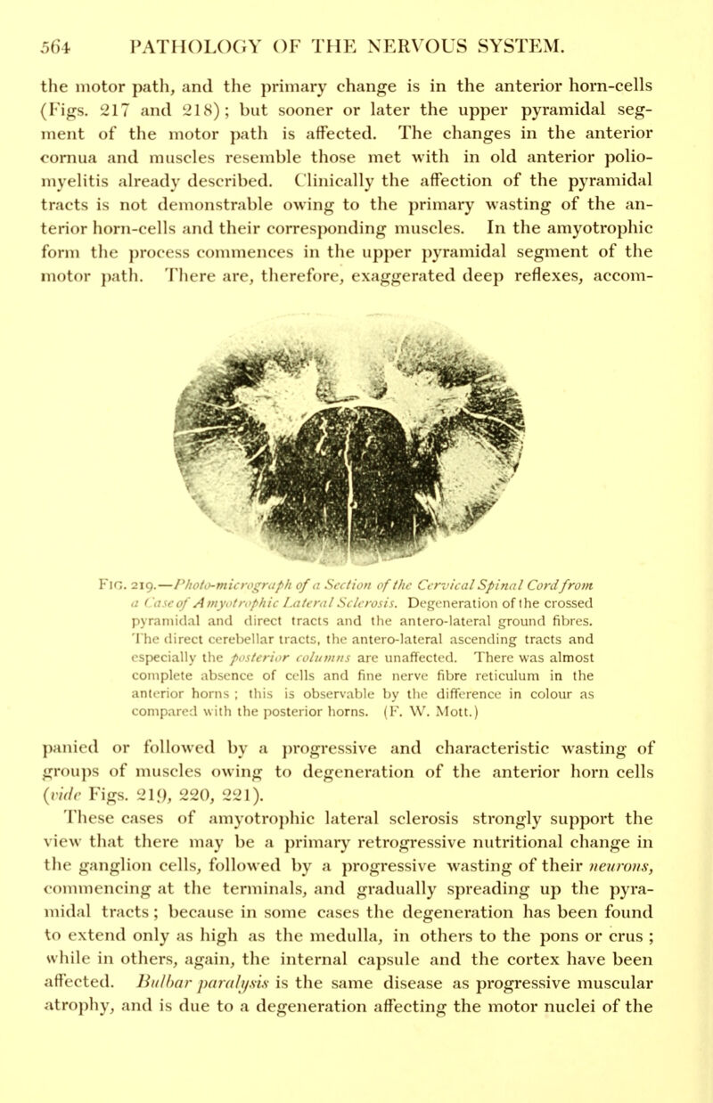 the motor path, and the primary change is in the anterior horn-cells (Figs. 217 and 218); but sooner or later the upper pyramidal seg- ment of the motor path is affected. The changes in the anterior cornua and muscles resemble those met with in old anterior polio- myelitis already described. Clinically the affection of the pyramidal tracts is not demonstrable owing to the primary wasting of the an- terior horn-cells and their corresponding muscles. In the amyotrophic form the jirocess commences in the upper pyramidal segment of the motor })ath. There are, therefore, exaggerated deep reflexes, accom- FlG. 219.—Photi)-microi^)\:l it vf,: .s<. .,,7, ,/ Cervical Spinal Cord from a ( asc of A myot rophic Lateral Sclerosis. Degeneration of the crossed pyramidal and direct tracts and the antero-lateral ground fibres. The direct cerebellar tracts, the antero-lateral ascending tracts and especially the posterior colimins are unaffected. There was almost complete absence of cells and fine nerve fibre reticulum in the anterior horns ; this is observable by the difference in colour as compared with the posterior liorns. (F. W. Mott.) panied or followed by a })rogressive and characteristic wasting of groups of muscles owing to degeneration of the anterior horn cells {vide Figs. 21.9, 220, 221). 'I'hese cases of amyotroj)hic lateral sclerosis strongly support the view that there may be a primary retrogressive nutritional change in the ganglion cells, followed by a progressive wasting of their neurons, commencing at the terminals, and gradually spreading up the pyra- midal tracts ; because in some cases the degeneration has been found to extend only as high as the medulla, in others to the pons or crus ; while in others, again, the internal ca})side and the cortex have been aflected. Ihdhar panili/.sis is the same disease as progressive muscular atrophy, and is due to a degeneration affecting the motor nuclei of the