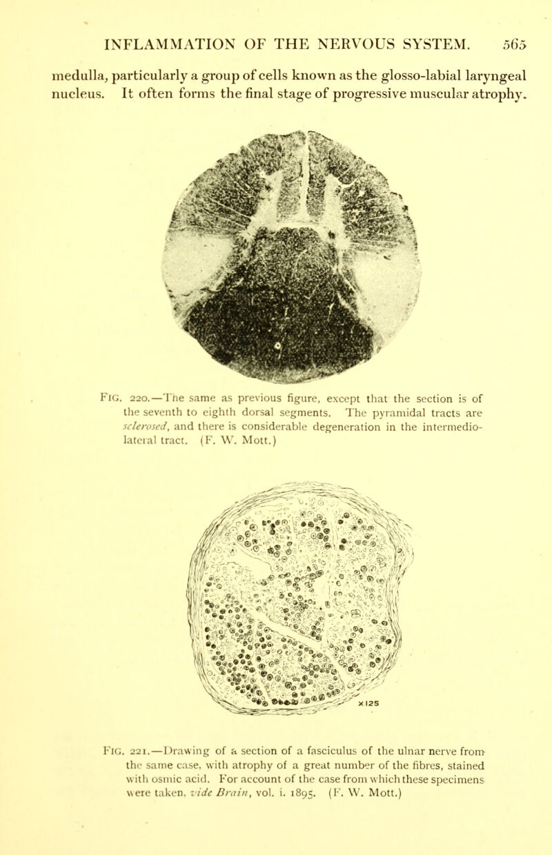 medulla, particularly a group of cells knovvn as the glosso-labial laryngeal nucleus. It often forms the final stage of progressive muscular atrophy. F^iG. 220.—The same as picvi(jus figure, except that the section is of the seventh to eighth dorsal segments. The pyramidal tracts are sclerosed, and there is considerable degeneration in the intermedio- lateial tract. (F. W. Mott.) Fig. 221.—Drawing of a section of a fasciculus of the ulnar nerve from the same case, with atrophy of a great number of the fibres, stained witli osmic acid. For account of the case from which these specimens were taken, vide Brain, vol. i. 1895. (F. W. Mott.)