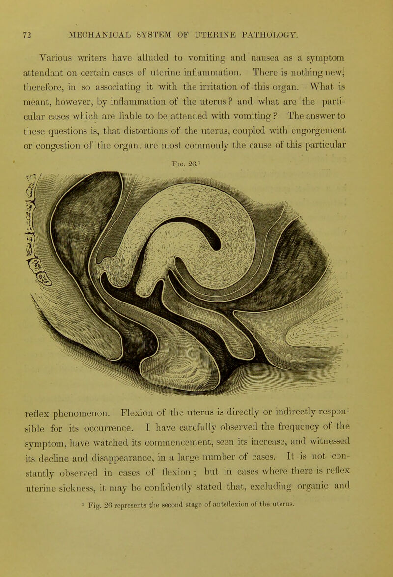 Various writers have alluded to vomiting and nausea as a symptom attendant on certain cases of uterine inflammation. There is nothing new, therefore, in so associating it with the irritation of this organ. What is meant, however, by inflammation of the uterus ? and what are the parti- cular cases which are liable to be attended with vomiting ? The answer to these questions is, that distortions of the uterus, coupled with engorgement or congestion of the organ, are most commonly the cause of this particular Fig. 26.» reflex phenomenon. Flexion of the uterus is directly or indirectly respon- sible for its occurrence. I have carefully observed the frequency of the symptom, have watched its commencement, seen its increase, and witnessed its dechne and disappearance, in a large number of cases. It is not con- stantly observed in cases of flexion ; but in cases where there is reflex uterine sickness, it may be confidently stated that, excluding organic and ' Fig-. 20 represents tlie second stage of autefle.vion of the uterus.