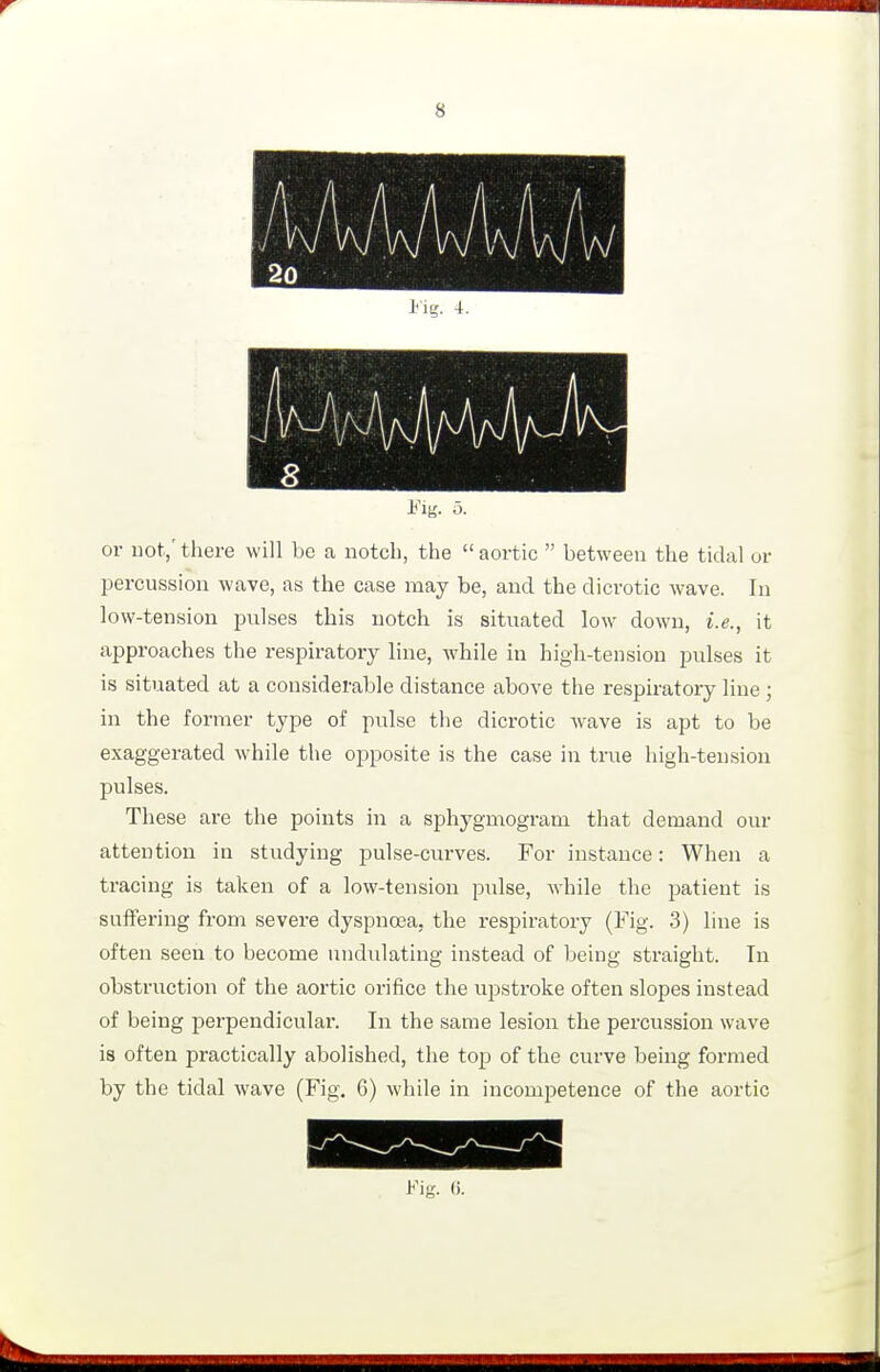 Fig. 5. or not/ there will be a notch, the  aortic  between the tidal or Ijercussion wave, as the case may be, and the dicrotic wave. In low-tension pulses this notch is situated low down, i.e., it approaches the respii-atory line, while in high-tension pulses it is situated at a considerable distance above the respiratory line; in the former type of pulse the dicrotic wave is apt to be exaggerated while the opposite is the case in true high-tension pulses. These are the points in a sphygmogram that demand our attention in studying pulse-curves. For instance: When a tracing is taken of a low-tension pulse, while the patient is suffering from severe dyspnoea, the respiratory (Fig. 3) line is often seen to become undulating instead of being straight. In obstruction of the aortic orifice the upstroke often slopes instead of being perpendicular. In the same lesion the percussion wave is often practically abolished, the top of the curve being formed by the tidal wave (Fig. 6) while in incompetence of the aortic