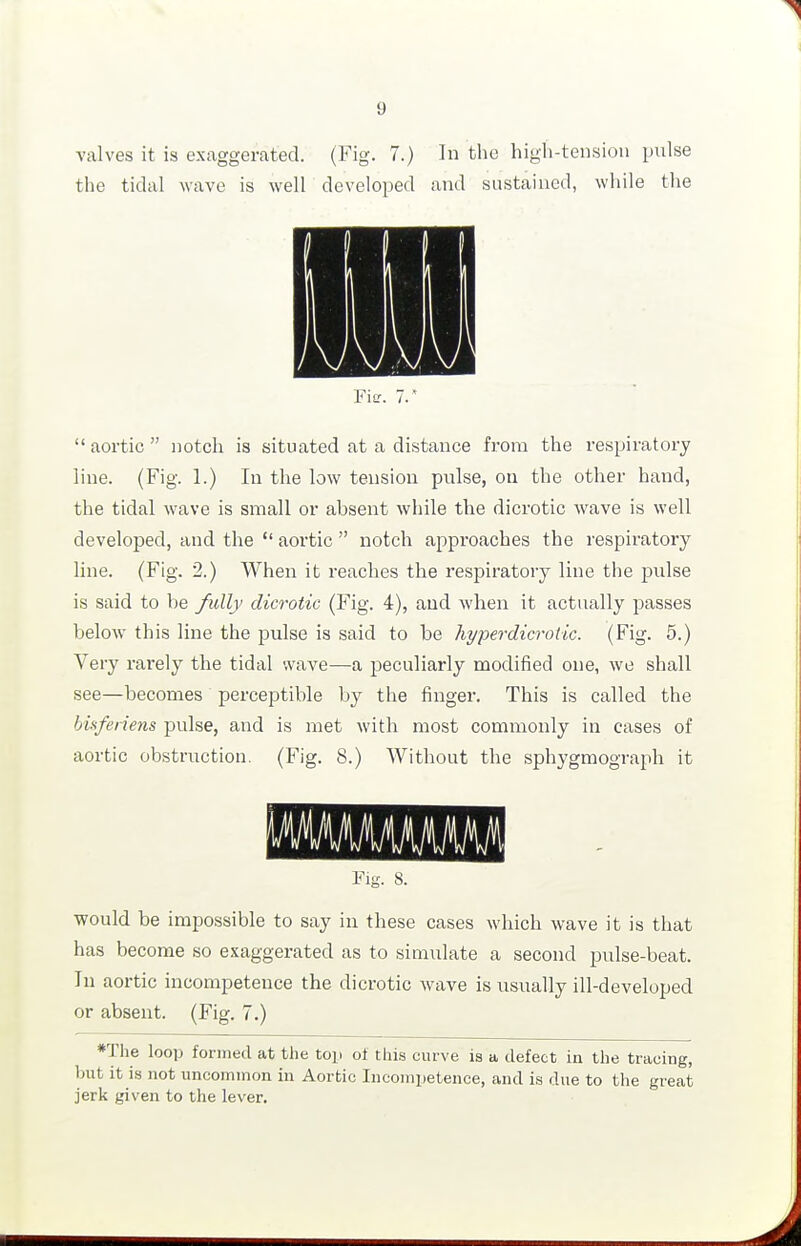 valves it is exaggerated. (Fig. 7.) In tlie high-tension pulse the tidal wave is well developed and sustained, while the Fitr. 7.  aortic  notch is situated at a distance from the respiratory line. (Fig. 1.) In the low tension pulse, on the other hand, the tidal wave is small or absent while the dicrotic wave is well developed, and the  aortic  notch approaches the respiratory line. (Fig. 2.) When it reaches the respiratory line the pulse is said to be fully dicrotic (Fig. 4), and when it actually passes below this line the pulse is said to be hyper dicrotic. (Fig. 5.) Very rarely the tidal wave—a j^eculiarly modified one, we shall see—becomes perceptible by the finger. This is called the bisferiens pulse, and is met with most commonly in cases of aortic obstruction. (Fig. 8.) Without the sphygmograph it Fig. 8. would be impossible to say in these cases which wave it is that has become so exaggerated as to simulate a second pulse-beat, lu aortic incompetence the dicrotic wtxve is usually ill-developed or absent. (Fig. 7.) *The loop formed at the toi. ot tliis curve is a, defect in the tracing, but it is not uncommon in Aortic Incompetence, and is due to the great jerk given to the lever.