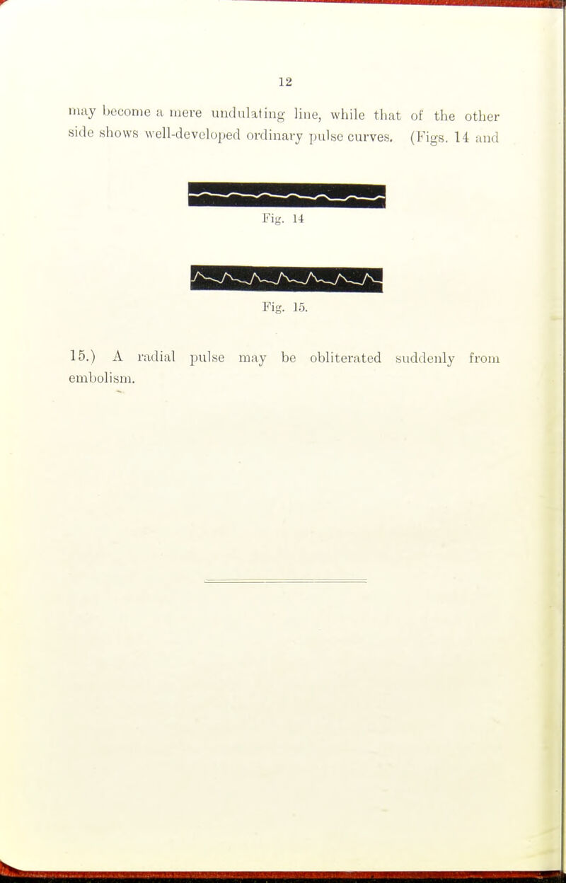 may become a mere undulating line, while that of the other side shows well-developed ordinary pulse curves. (Figs. 14 and Fig. 15. 15.) A radial pulse may be obliterated suddenly from embolism.