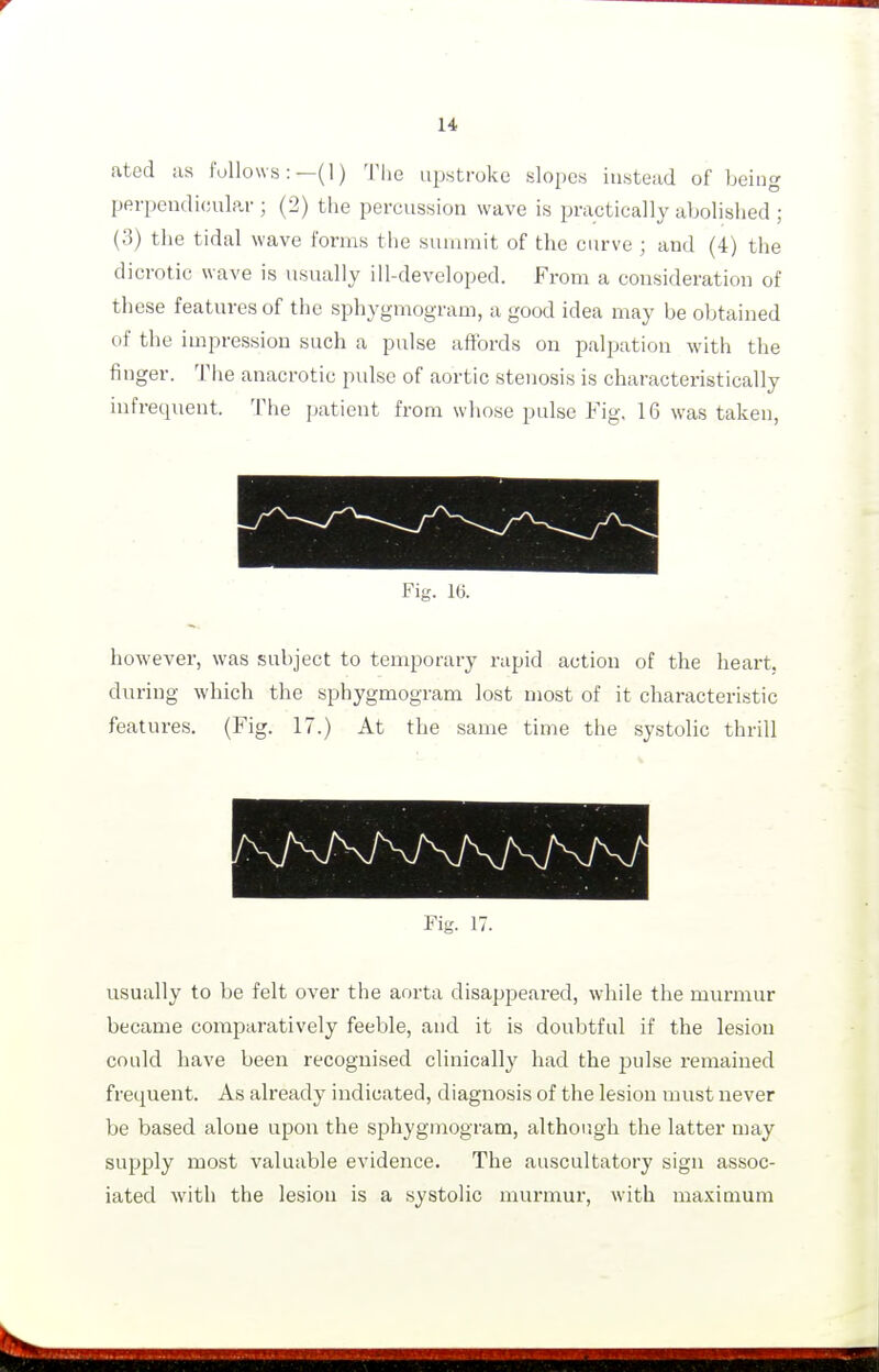 ated as follows:—(]) The upstroke slopes instead of being perpendicular ; (2) the percussion wave is practically abolished ; (3) tlie tidal wave forms the summit of the curve ; and (4) the dicrotic wave is usually ill-developed. From a cousideration of these features of the sphygmogram, a good idea may be obtained of the impression such a pulse affords on palpation with the finger. The anacrotic pulse of aortic stenosis is characteristically infrequent. The patient from whose pulse Fig. 16 was taken, Fig. however, was subject to temporary rapid action of the heart, din-ing which the sphygmogram lost most of it characteristic features. (Fig. 17.) At the same time the systolic thrill Fig. 17. usually to be felt over the aorta disappeared, while the murmur became comparatively feeble, and it is doubtful if the lesion could have been recognised clinically had the pulse remained frequent. As already indicated, diagnosis of the lesion must never be based alone upon the sphygmogram, although the latter may supply most valuable evidence. The auscultatory sign assoc- iated with the lesion is a systolic murmur, with maximum