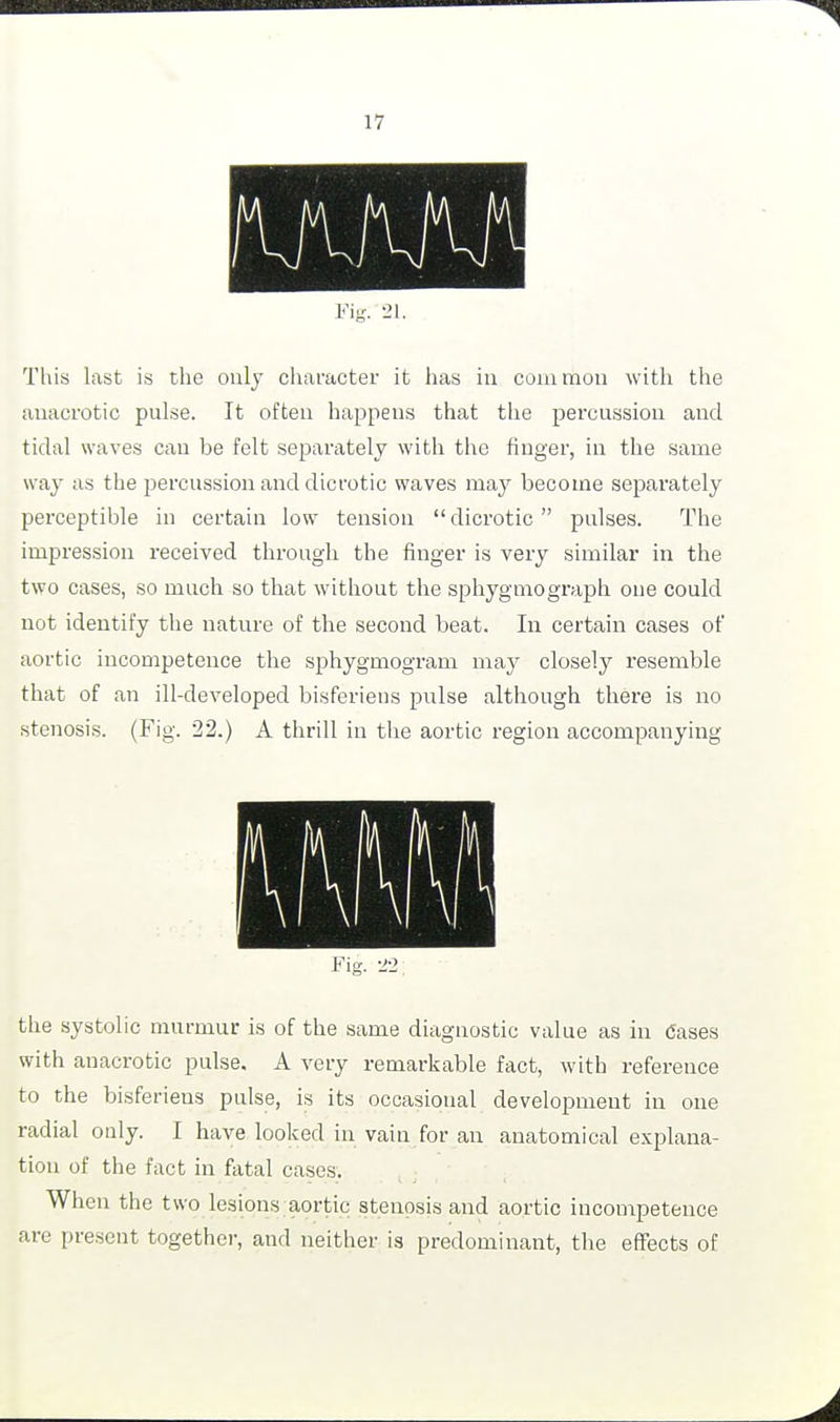 Fig. -21. This last is the only character it has in common with the anacrotic pulse. It often happens that the percussion and tidal waves can be felt separately with the finger, in the same way as the percussion and dicrotic waves may become separately perceptible in certain low tension dicrotic pulses. The impression received through the finger is very similar in the two cases, so much so that without the sphygmograph one could not identify the nature of the second beat. In certain cases of aortic incompetence the sphygmogram may closely resemble that of an ill-developed bisferiens pulse although there is no stenosis. (Fig. 22.) A thrill in the aortic region accompanying Fig. -22, the systolic murmur is of the same diagnostic value as in Cases with anacrotic pulse. A very remarkable fact, with reference to the bisferiens pulse, is its occasional development in one radial only. I have looked in vain for an anatomical explana- tion of the fact in fatal cases. When the two lesions aortic stenosis and aortic incompetence are present together, and neither is predominant, the effects of