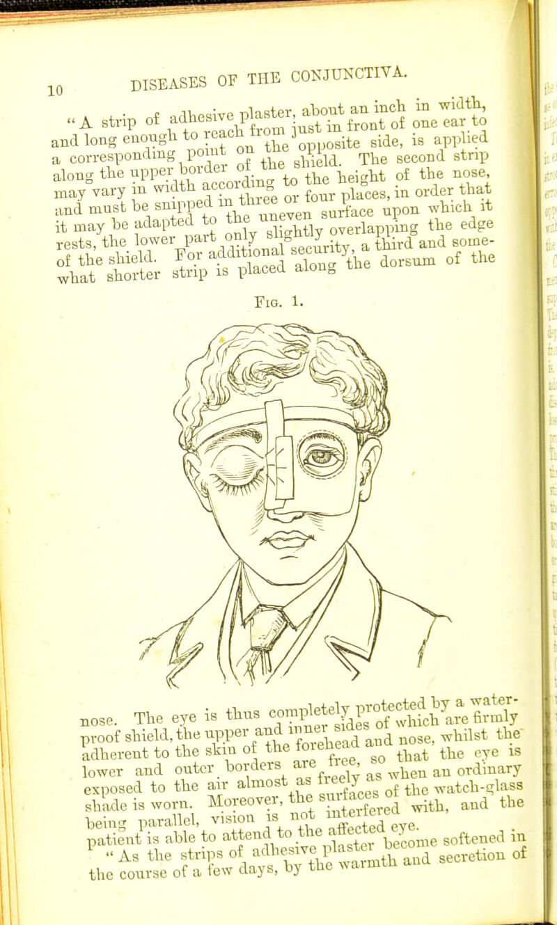 wai^^^ffk^WpS side, is applied a corresponding point on ^ opi gtnp along the ^^^J^^Sb height of the nose may vary m wldth^?Xree or four places, in order that Fig. 1. nose. The eye is thus proof shield, the uppei-and^^4 nose) whilst tbe Uherent to the skin of the tmeneaa ^ ^e u lower and outer, borders arei»e, .0 ^ ordinary exposed to the air almost aa iieelya watcn.„iaSg shade is worn. Moreover, the s^ aud the being parallel, vision is not ™g™JL patient is able to ^i^^T&B softened in 1 As the strips of adhesive, Poster ° seCretion of the course of a few days, by the warmth ana