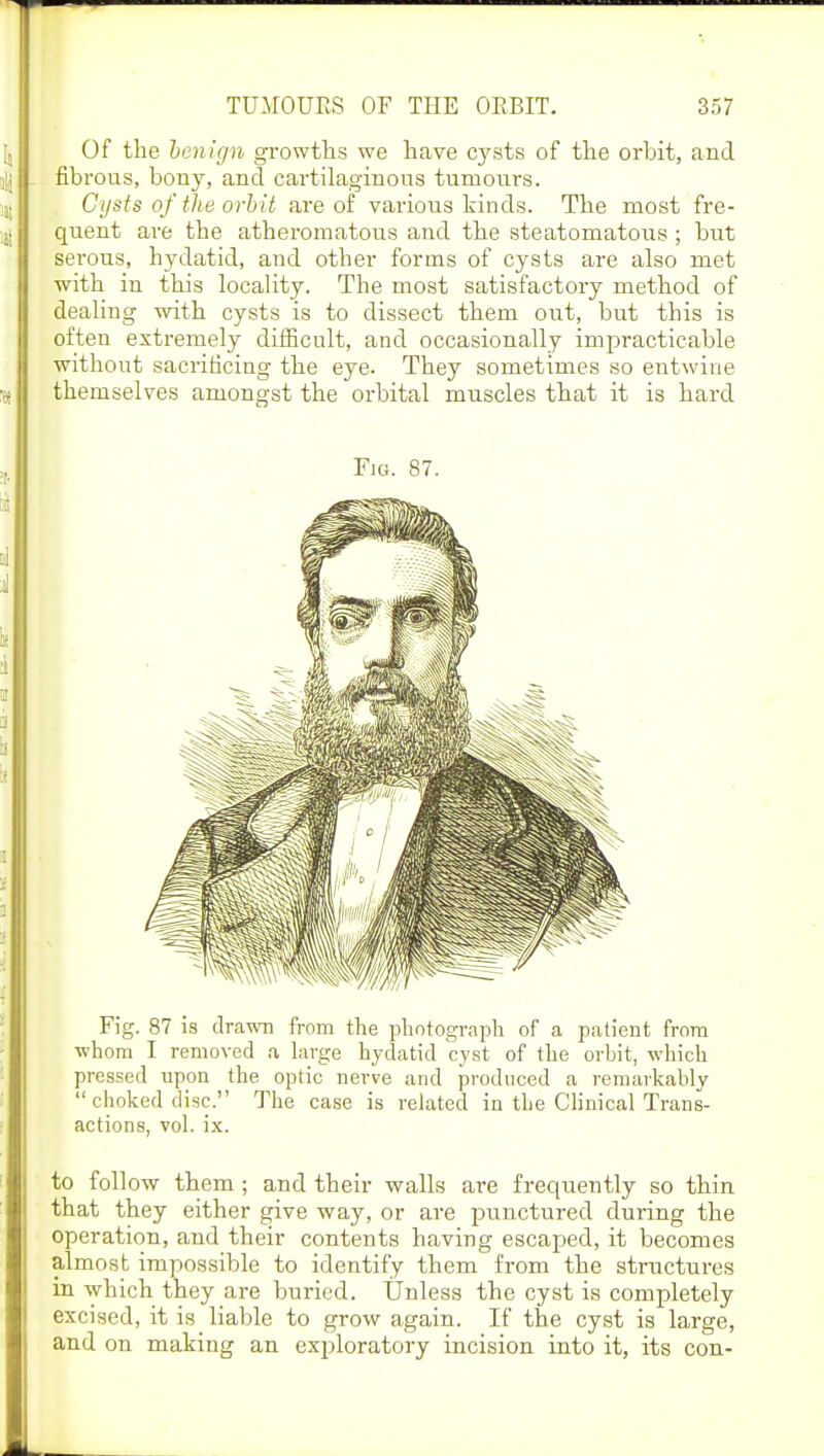Of the benign growths we have cysts of the orbit, and fibrous, bony, and cartilaginous tumours. Cysts of the orbit are of various kinds. The most fre- quent are the atheromatous and the steatomatosis; but serous, hydatid, and other forms of cysts are also met with in this locality. The most satisfactory method of dealing with cysts is to dissect them out, but this is often extremely difficult, and occasionally impracticable without sacrificing the eye. They sometimes so entwine themselves amongst the orbital muscles that it is hard Fig. 87. Fig. 87 is drawn from the photograph of a patient from whom I removed a large hydatid cyst of the orbit, which pressed upon the optic nerve and produced a remarkably  choked disc. The case is related in the Clinical Trans- actions, vol. ix. to follow them; and their walls are frequently so thin that they either give way, or are punctured during the operation, and their contents having escaped, it becomes almost impossible to identify them from the structures in which they are buried. Unless the cyst is completely excised, it is liable to grow again. If the cyst is large, and on making an exploratory incision into it, its con-