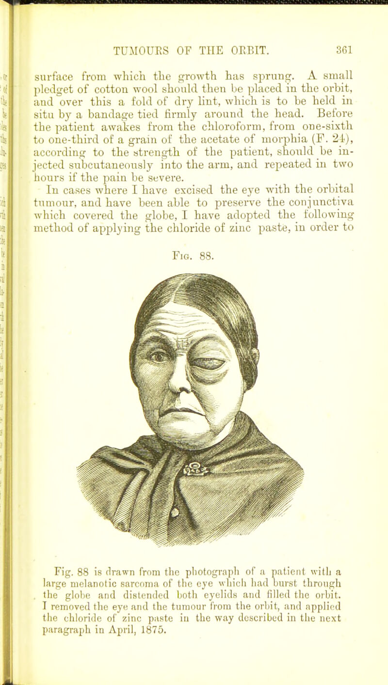 surface from which the growth has sprung. A small pledget of cotton wool should then be placed in the orbit, and over this a fold of dry lint, which is to be held in situ by a bandage tied firmly around the head. Before the patient awakes from the chloroform, from one-sixth to one-third of a grain of the acetate of morphia (F. 24), according to the strength of the patient, should be in- jected subcutaneously into the arm, and repeated in two hours if the pain be severe. In cases where I have excised the eye with the orbital tumour, and have been able to preserve the conjunctiva which covered the globe, I have adopted the following method of applying the chloride of zinc paste, in order to Fig. 88. Fig. 88 is drawn from the photograph of a patient with a large melanotic sarcoma of the eye which had burst through the globe and distended both eyelids and filled the orbit. I removed the eye and the tumour from the orbit, and applied the chloride of zine paste iu the way described in the next paragraph in April, 1875.