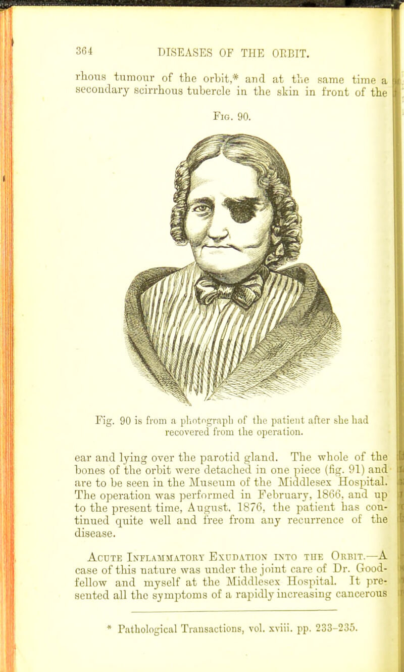 rhous tumour of the orbit * and at the same time a secondary scirrhous tubercle in the skin in front of the Fig. 90. Fig. 90 is from a photograph of the patient after she had recovered from the operation. ear and lying over the parotid gland. The whole of the bones of the orbit were detached in one piece (fig. 91) and are to be seen in the Museum of the Middlesex Hospital. The operation was performed in February, 1866, and up to the present time, August, 1876, the patient has con- tinued quite well and free from any recurrence of the disease. Acute Inflammatory Exudation into the Orbit.—A case of this nature was under the joint care of Dr. Good- fellow and myself at the Middlesex Hospital. It pre- sented all the symptoms of a rapidly increasing cancerous