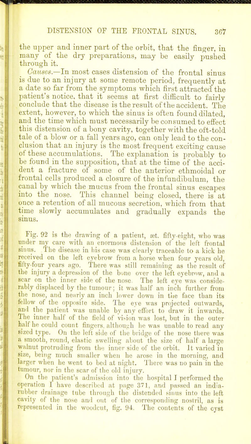 the upper and inner part of the orbit, that the finger, in many of the dry preparations, may be easily pushed through it. Causes.—In most cases distension of the frontal sinus is due to an injury at some remote period, frequently at a date so far from the symptoms which first attracted the patient's notice, that it seems at first difficult to fairly conclude that the disease is the result of the accident. The extent, however, to which the sinus is often found dilated, and the time which must necessarily be consumed to effect this distension of a bony cavity, together with the oft-told tale of a blow or a fall yeai*s ago, can only lead to the con- clusion that an injury is the most frequent exciting cause of these accumulations. The explanation is probably to be found in the supposition, that at the time of the acci- dent a fracture of some of the anterior ethmoidal or frontal cells produced a closure of the infundibulum, the canal by which the mucus from the frontal sinus escapes into the nose. This channel being closed, there is at once a retention of all mucous secretion, which from that time slowly accumulates and gradually expands the sinus. Fig. 92 is the drawing of a patient, vet. fifty-eight, who was under my care with an enormous distension of the left frontal sinus. The disease in liis case was clearly traceable to a kick he received on the left eyebrow from a horse when four years old, fifty-four years ago. There was still remaining as the result of the injury a depression of the bune over the left eyebrow, and a scar on the inner side of the nose. The left eye was conside- rably displaced by the tumour; it was half an inch further from the nose, and ne;irly an inch lower down in the face than its fellow of the opposite side. The eye was projected outwards, and the patient was unable by any effort to draw it inwards. The inner half of the field of vision was lost, but in the outer half he could count fingers, although he was unable to read any sized type. On the left side of the bridge of the nose there was a smooth, round, elastic swelling about the size of half a large walnut protruding from the inner side of the orbit. It varied in size, being much smaller when he arose in the morning, and larger when he went to bed at night. There was no pain in the tumour, nor in the scar of the old injury. On the patient's admission into the hospital I performed the operation I have described at page 371, and passed an india- fcubber drainage tube through the distended sinus into the left cavity of the nose and out of the corresponding nostril, as is represented in the woodcut, fig. 94. The contents of the cyst