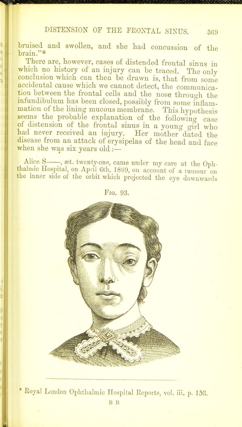 bruised and swollen, and she had concussion of the brain.* There are, however, cases of distended frontal sinus in which no history of an injury can be traced. The only conclusion which can then be drawn is, that from some accidental cause which we cannot detect, the communica- tion between the frontal cells and the nose throuoh the infundibulum has been closed, possibly from some inflam- mation of the lining mucous membrane. This hypothesis seems the probable explanation of the following case of distension of the frontal sinus in a young girl who had never received an injury. Her mother°dated the disease from an attack of erysipelas of the head and face when she was six years old:— Alice. S , ret. twenty-one, came under my care at the Oph- thalmic Hospital, on April 6th, 1869, on account of a tumour on the inner side of the orbit which projected the eye downwards Fig. 93. * Pvoyal London Ophthalmic Hospital Reports, vol. iii. p. 153. B B