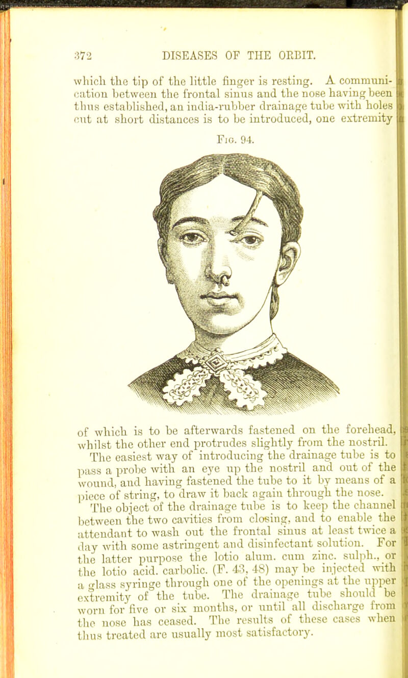 which the tip of the little finger is resting. A communi- cation between the frontal sinus and the nose having been thus established, an india-rubber drainage tube with holes cut at short distances is to be introduced, one extremity Fie. 94. of which is to be afterwards fastened on the forehead, whilst the other end protrudes slightly from the nostril. The easiest way of introducing the drainage tube is to pass a probe with an eye up the nostril and out of the wound, and having fastened the tube to it by means of a piece of string, to draw it back again through the nose. The object'of the drainage tube is to keep the channel between the two cavities from closing, aud to enable_ the attendant to wash out the frontal sinus at least twice a day with some astringent and disinfectant solution. For the latter purpose the lotio alum, cum zinc, sulph., or the lotio acid, carbolic. (F. 43, 48) may be injected with a <>iass syringe through one of the openings at the upper extremity of the tube. The drainage tube should be worn for five or six months, or until all discharge from 11)0 nose has ceased. The results of these eases when thus treated are usually most satisfactory.