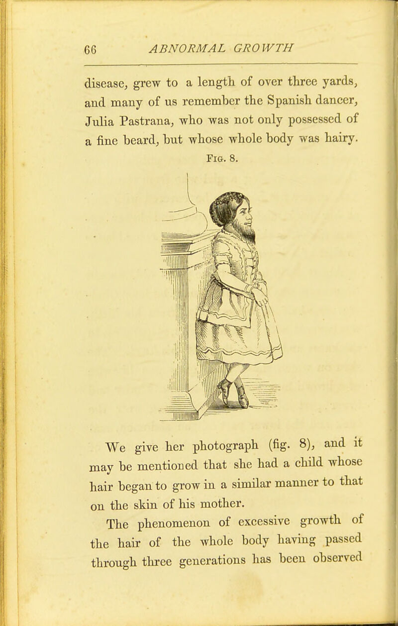 disease, grew to a length of over three yards, and many of us remember the Spanish dancer, Julia Pastrana, who was not only possessed of a fine beard, but whose whole body was hairy. Fig. 8. We give her photograph (fig. 8), and it may be mentioned that she had a child whose hair began to grow in a similar manner to that on the skin of his mother. The phenomenon of excessive growth of the hair of the whole body having passed through three generations has been observed