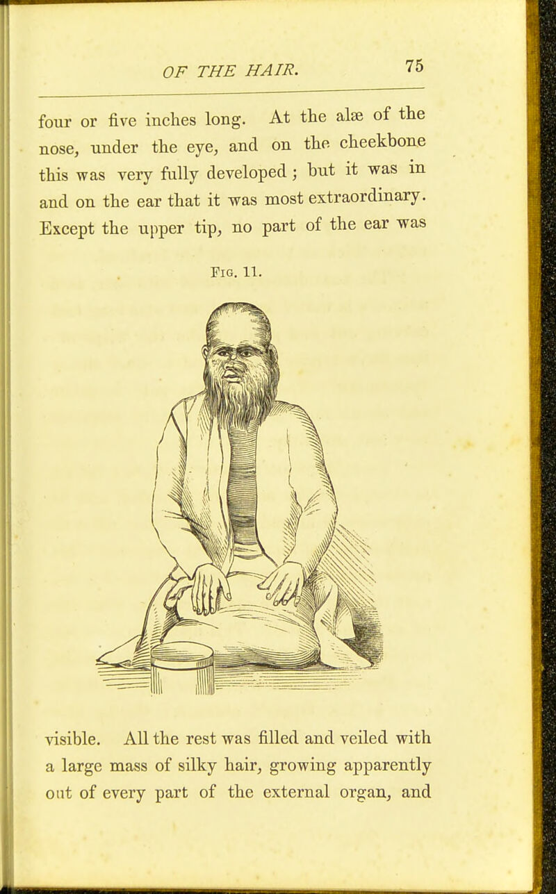 76 four or five inches long. At the alse of the nose, under the eye, and on the cheekbone this was very fully developed; but it was in and on the ear that it was most extraordinary. Except the upper tip, no part of the ear was Fig. 11. visible. All the rest was filled and veiled with a large mass of silky hair, growing apparently out of every part of the external organ, and
