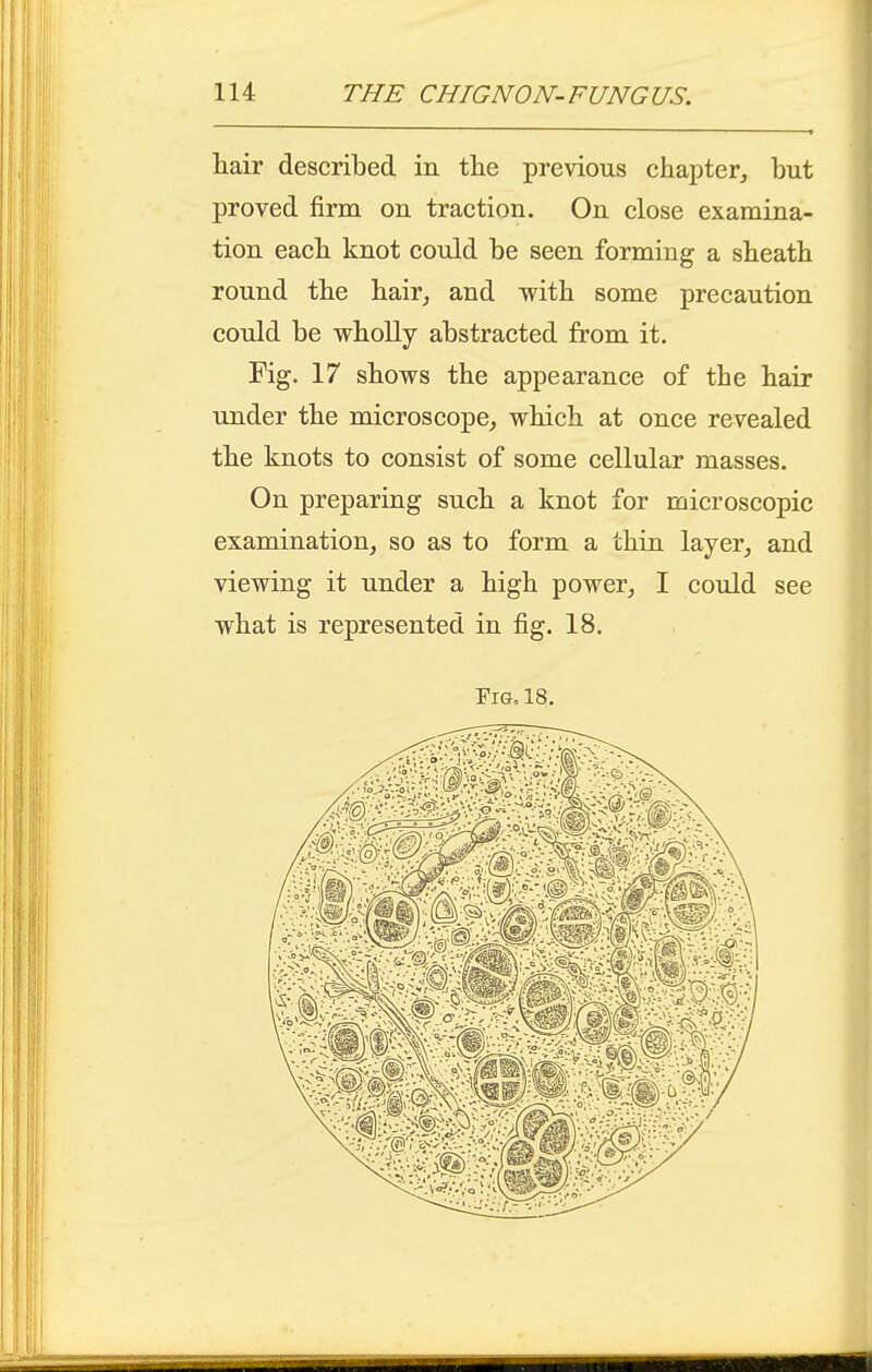 hair described in tlie previous chapter^ but proved firm on traction. On close examina- tion eacb knot could be seen forming a sheath round the hair^ and with some precaution could be wholly abstracted from it. Fig. 17 shows the appearance of the hair under the microscope, which at once revealed the knots to consist of some cellular masses. On preparing such a knot for microscopic examination, so as to form a thin layer, and viewing it under a high power, I could see what is represented in fig. 18. Fig. 18.