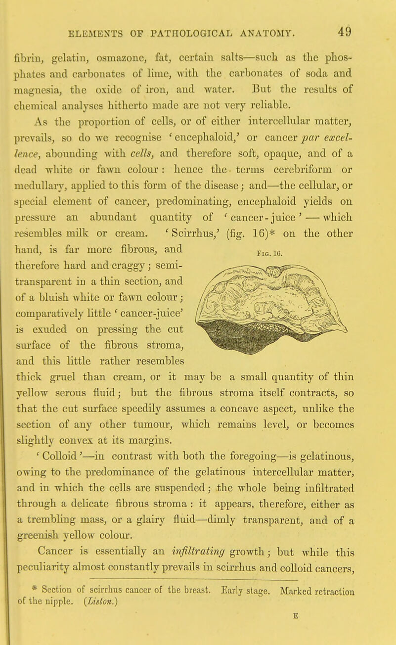 fibriuj gelatin^ osmazonc, fat, certain salts—such as the phos- phates and carbonates of lime, Avith the carbonates of soda and magnesia, the oxide of iron, and water. But the results of chemical analyses hitherto made are not very reliable. As the proportion of cells, or of either intercellular matter, prevails, so do we recognise ' encephaloid,' or cancer par excel- lence, abounding with cells, and therefore soft, opaque, and of a dead white or fawn colour: hence the terms cerebriform or medullary, applied to this form of the disease; and—the cellular, or special element of cancer, predominating, encephaloid yields on pressure an abundant quantity of ^ cancer-juice'—which resembles milk or cream. ' Scii'rhus,^ (fig. 16)* on the other hand, is far more fibrous, and therefore hard and craggy; semi- transparent in a thin section, and of a bluish white or fawn colour; comparatively little ' cancer-juice' is exuded on pressing the cut surface of the fibrous stroma, and this little rather resembles thick gruel than cream, or it may be a small quantity of thin yellow serous fluid; but the fibrous stroma itself contracts, so that the cut surface speedily assumes a concave aspect, unlike the section of any other tumour, which remains level, or becomes slightly convex at its margins. ' Colloid'—in contrast with both the foregoing—is gelatinous, owing to the predominance of the gelatinous intercellular matter, and in which the cells are suspended; the whole being infiltrated through a delicate fibrous stroma : it appears, therefore, either as a trembling mass, or a glairy fluid—dimly transparent, and of a greenish yellow colour. Cancer is essentially an infiltrating growth; but while this peculiarity almost constantly prevails in scirrhus and colloid cancers, * Section of scirrhus cancer of the breast. Early stage. Marked retraction of the nipple. {Liston.) Fis. 16.