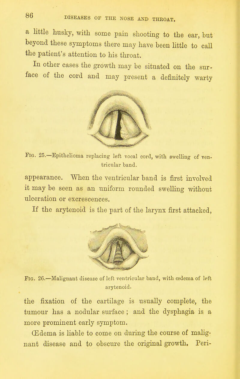 a little husky, with some paiu shootuag to the ear, but beyond these symptoms there may have been httle to caU the patient's attention to his throat. In other cases the growth may be situated on the sur- face of the cord and may present a definitely warty Fig. 25.—Epithelioma replacing left vocal cord, with swelling of ven- appearance. When the ventricular band is first involved it may be seen as an uniform rounded sweUing without ulceration or excrescences. If the arytenoid is the part of the larynx first attacked, Fig. 26.—Malignant disease of left ventricular band, with oedema of left the fixation of the cartilage is usually complete, the tumour has a nodular surface ; and the dysphagia is a more prominent early symptom. CEdema is liable to come on during the course of malig- nant disease and to obscure the original growth. Peri- tricular band. arytenoid.