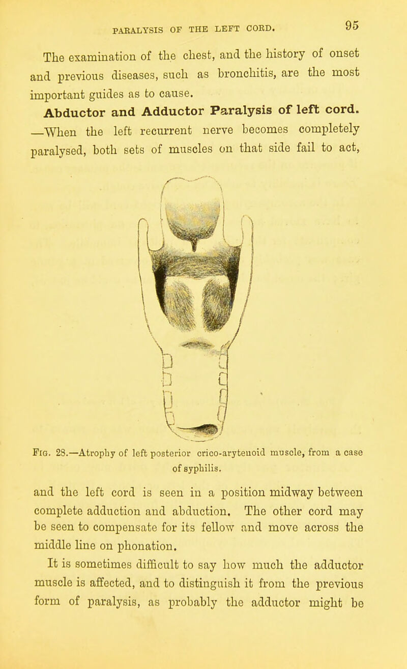 The examination of the chest, and the history of onset and previous diseases, such as bronchitis, are the most important guides as to cause. Abductor and Adductor Paralysis of left cord. —When the left recurrent nerve becomes completely paralysed, both sets of muscles on that side fail to act, and the left cord is seen in a position midway between complete adduction and abduction. The other cord may be seen to compensate for its fellow and move across the middle line on phonation. It is sometimes difficult to say how much the adductor muscle is affected, and to distinguish it from the previous form of paralysis, as probably the adductor might be Fig. 28.—Atrophy of left posterior crico-aryteuoid muscle, from a case of sypbilis.