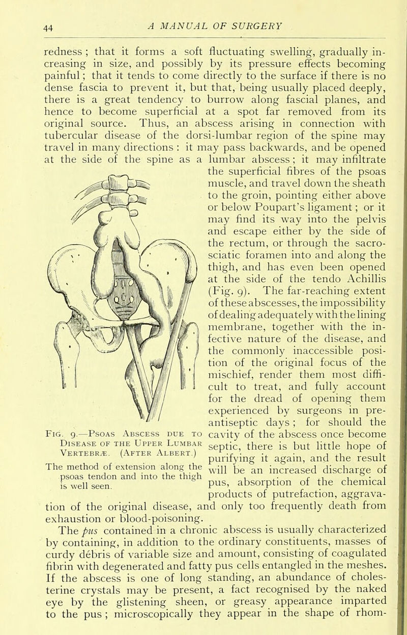 at the side of the spine redness ; that it forms a soft fluctuating swelling, gradually in- creasing in size, and possibly by its pressure effects becoming painful; that it tends to come directly to the surface if there is no dense fascia to prevent it, but that, being usually placed deeply, there is a great tendency to burrow along fascial planes, and hence to become superficial at a spot far removed from its original source. Thus, an abscess arising in connection with tubercular disease of the dorsi-lumbar region of the spine may travel in many directions : it may pass backwards, and be opened as a lumbar abscess; it may infiltrate the superficial fibres of the psoas muscle, and travel down the sheath to the groin, pointing either above or below Poupart's ligament; or it may find its way into the pelvis and escape either by the side of the rectum, or through the sacro- sciatic foramen into and along the thigh, and has even been opened at the side of the tendo Achillis (Fig. 9). The far-reaching extent of these abscesses, the impossibility of dealing adequately with the lining membrane, together with the in- fective nature of the disease, and the commonly inaccessible posi- tion of the original focus of the mischief, render them most diffi- cult to treat, and fully account for the dread of opening them experienced by surgeons in pre- antiseptic days ; for should the cavity of the abscess once become septic, there is but little hope of purifying it again, and the result will be an increased discharge of pus, absorption of the chemical products of putrefaction, aggrava- tion of the original disease, and only too frequently death from exhaustion or blood-poisoning. The pus contained in a chronic abscess is usually characterized by containing, in addition to the ordinary constituents, masses of curdy debris of variable size and amount, consisting of coagulated fibrin with degenerated and fatty pus cells entangled in the meshes. If the abscess is one of long standing, an abundance of choles- terine crystals may be present, a fact recognised by the naked eye by the glistening sheen, or greasy appearance imparted to the pus ; microscopically they appear in the shape of rhom- Fig. g.—Psoas Abscess due to Disease of the Upper Lumbar Vertebra. (After Albert.) The method of extension along the psoas tendon and into the thigh is well seen.