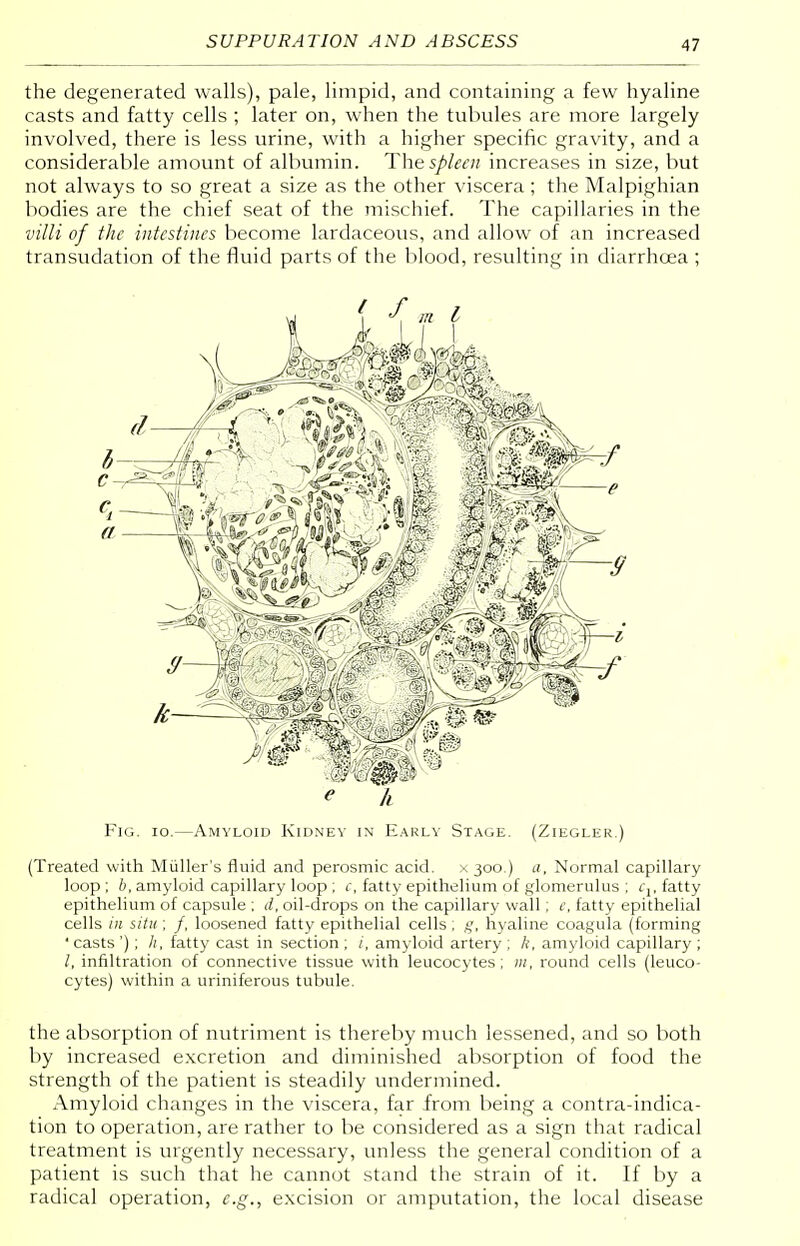 17 the degenerated walls), pale, limpid, and containing a few hyaline casts and fatty cells ; later on, when the tubules are more largely involved, there is less urine, with a higher specific gravity, and a considerable amount of albumin. The spleen increases in size, but not always to so great a size as the other viscera; the Malpighian bodies are the chief seat of the mischief. The capillaries in the villi of the intestines become lardaceous, and allow of an increased transudation of the fluid parts of the blood, resulting in diarrhoea ; Fig. io.—Amyloid Kidney in Early Stage. (Ziegler.) (Treated with Muller's fluid and perosmic acid. x 300.) a, Normal capillary loop; b, amyloid capillary loop ; c, fatty epithelium of glomerulus ; fj, fatty epithelium of capsule ; d, oil-drops on the capillary wall ; c, fatty epithelial cells in situ ; /, loosened fatty epithelial cells ; g, hyaline coagula (forming ' casts ') ; h, fatty cast in section ; i, amyloid artery ; /(, amyloid capillary ; infiltration of connective tissue with leucocytes; m, round cells (leuco- cytes) within a uriniferous tubule. the absorption of nutriment is thereby much lessened, and so both by increased excretion and diminished absorption of food the strength of the patient is steadily undermined. Amyloid changes in the viscera, far from being a contra-indica- tion to operation, are rather to be considered as a sign that radical treatment is urgently necessary, unless the general condition of a patient is such that he cannot stand the strain of it. If by a radical operation, e.g., excision or amputation, the local disease