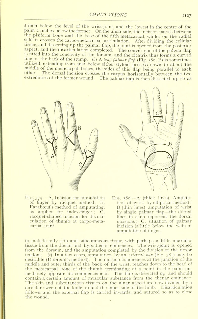 i inch below the level of the wrist-joint, and the lowest in the centre of the palm 2 inches below the former On the ulnar side, the incision passes between the pisiform bone and the base of the fifth metacarpal, whilst on the radial side it crosses the carpo-metacarpal articulation. After dividing the cellular tissue, and dissecting up the palmar flap, the joint is opened from the posterior aspect, and the disarticulation completed. The convex end of the palmar flap is fitted into the concavity of the dorsum, and the cicatrix thus forms a curved line on the back of the stump, (b) A long palmar flap (Fig. 380, B) is sometimes utilized, extending from just below either styloid process down to about the middle of the metacarpal bones, the sides of this flap being parallel to each other The dorsal incision crosses the carpus horizontally between the two extremities of the former wound. The palmar flap is then dissected up so as Fig. 379.—A, Incision for amputation of finger by racquet method; B, Farabceuf's method of amputating, as applied for index-finger ; C, racquet-shaped incision for disarti- culation of thumb at carpo-meta- carpal joint. Fig. 380.—A (thick lines). Amputa- tion of wrist by elliptical method ; B (thin lines), amputation of wrist by single palmar flap—the dotted lines in each represent the dorsal incisions; C, situation of palmar incision (a little below the web) in amputation of finger. to include only skin and subcutaneous tissue, with perhaps a little muscular tissue from the thenar and hypothenar eminences The wrist-joint is opened from the dorsum, and the amputation completed by the division of the flexor tendons, (c) In a few cases, amputation by an external flap (Fig. 381) may be desirable (Dubreuil's method). The incision commences at the junction of the middle and outer thirds of the back of the wrist, reaches down to the head of the metacarpal bone of the thumb, terminating at a point in the palm im- mediately opposite its commencement. This flap is dissected up, and should contain a certain amount of muscular substance from the thenar eminence. The skin and subcutaneous tissues on the ulnar aspect are now divided by a circular sweep of the knife around the inner side of the limb. Disarticulation follows, and the external flap is carried inwards, and sutured so as to close the wound