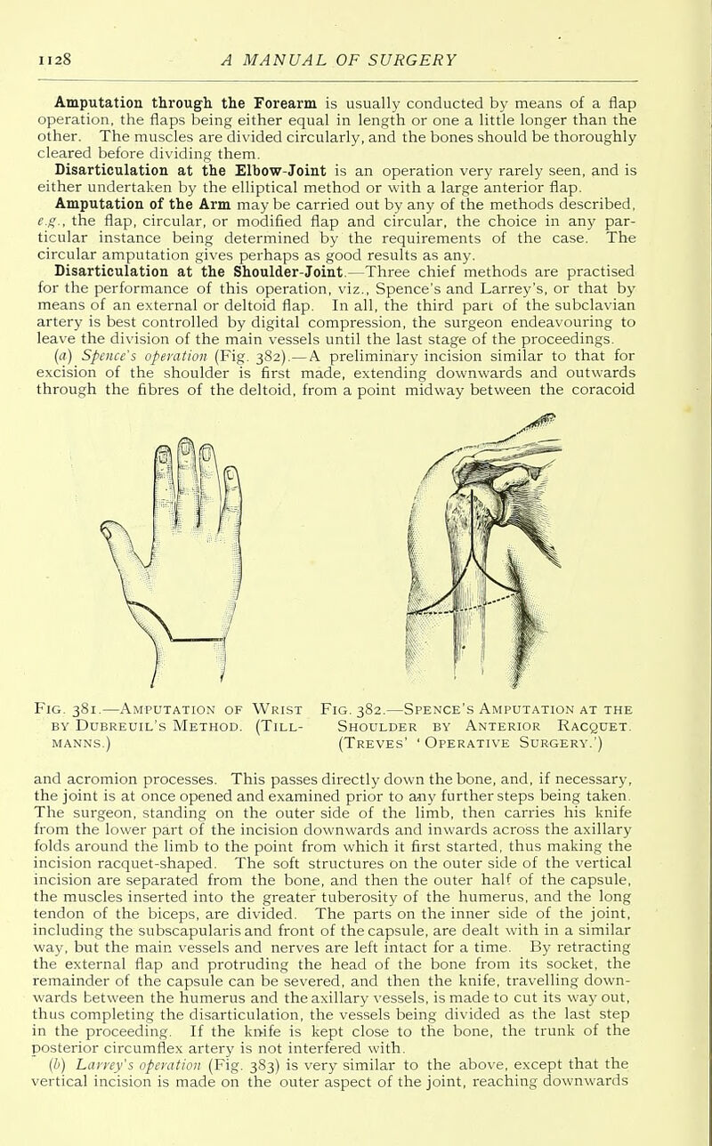Amputation through the Forearm is usually conducted by means of a flap operation, the flaps being either equal in length or one a little longer than the other. The muscles are divided circularly, and the bones should be thoroughly cleared before dividing them. Disarticulation at the Elbow-Joint is an operation very rarely seen, and is either undertaken by the elliptical method or with a large anterior flap. Amputation of the Arm may be carried out by any of the methods described, e.g., the flap, circular, or modified flap and circular, the choice in any par- ticular instance being determined by the requirements of the case. The circular amputation gives perhaps as good results as any. Disarticulation at the Shoulder-Joint.—Three chief methods are practised for the performance of this operation, viz., Spence's and Larrey's, or that by means of an external or deltoid flap. In all, the third part of the subclavian artery is best controlled by digital compression, the surgeon endeavouring to leave the division of the main vessels until the last stage of the proceedings. (a) Spence's operation (Fig. 382).—A preliminary incision similar to that for excision of the shoulder is first made, extending downwards and outwards through the fibres of the deltoid, from a point midway between the coracoid Fig. 381.—Amputation of Wrist Fig. 382.—Spence's Amputation at the by Dubreuil's Method. (Till- Shoulder by Anterior Racquet, manns.) (Treves' ' Operative Surgery.') and acromion processes. This passes directly down the bone, and, if necessary, the joint is at once opened and examined prior to any further steps being taken. The surgeon, standing on the outer side of the limb, then carries his knife from the lower part of the incision downwards and inwards across the axillary folds around the limb to the point from which it first started, thus making the incision racquet-shaped. The soft structures on the outer side of the vertical incision are separated from the bone, and then the outer half of the capsule, the muscles inserted into the greater tuberosity of the humerus, and the long tendon of the biceps, are divided. The parts on the inner side of the joint, including the subscapularis and front of the capsule, are dealt with in a similar way, but the main vessels and nerves are left intact for a time. By retracting the external flap and protruding the head of the bone from its socket, the remainder of the capsule can be severed, and then the knife, travelling down- wards between the humerus and the axillary vessels, is made to cut its way out, thus completing the disarticulation, the vessels being divided as the last step in the proceeding. If the knife is kept close to the bone, the trunk of the posterior circumflex artery is not interfered with. (6) Larrey's operation (Fig. 383) is very similar to the above, except that the vertical incision is made on the outer aspect of the joint, reaching downwards
